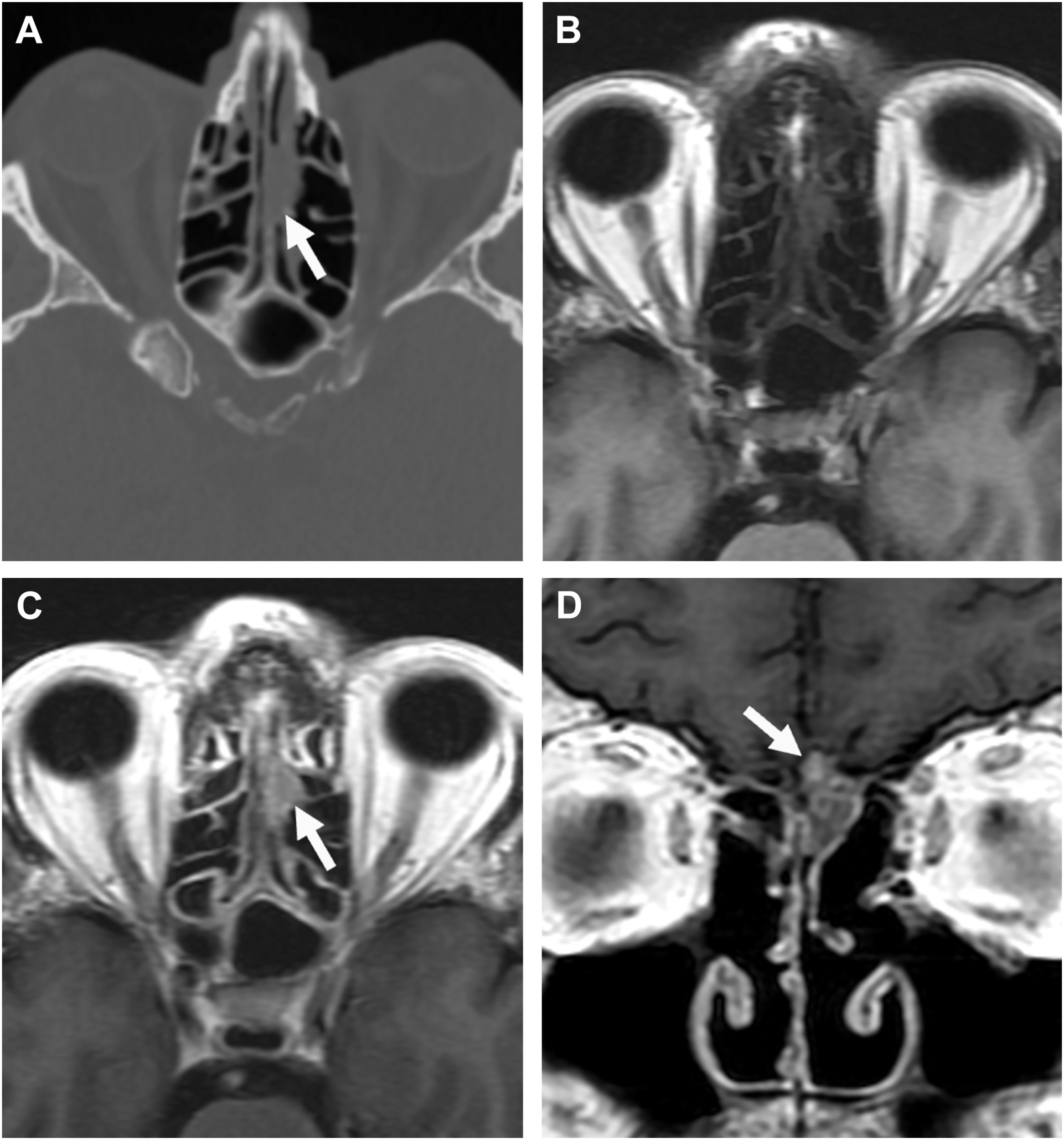 An axial and coronal CT and MRI series displays focal mass with arrow marks abnormality across four slices of the paranasal sinus region.