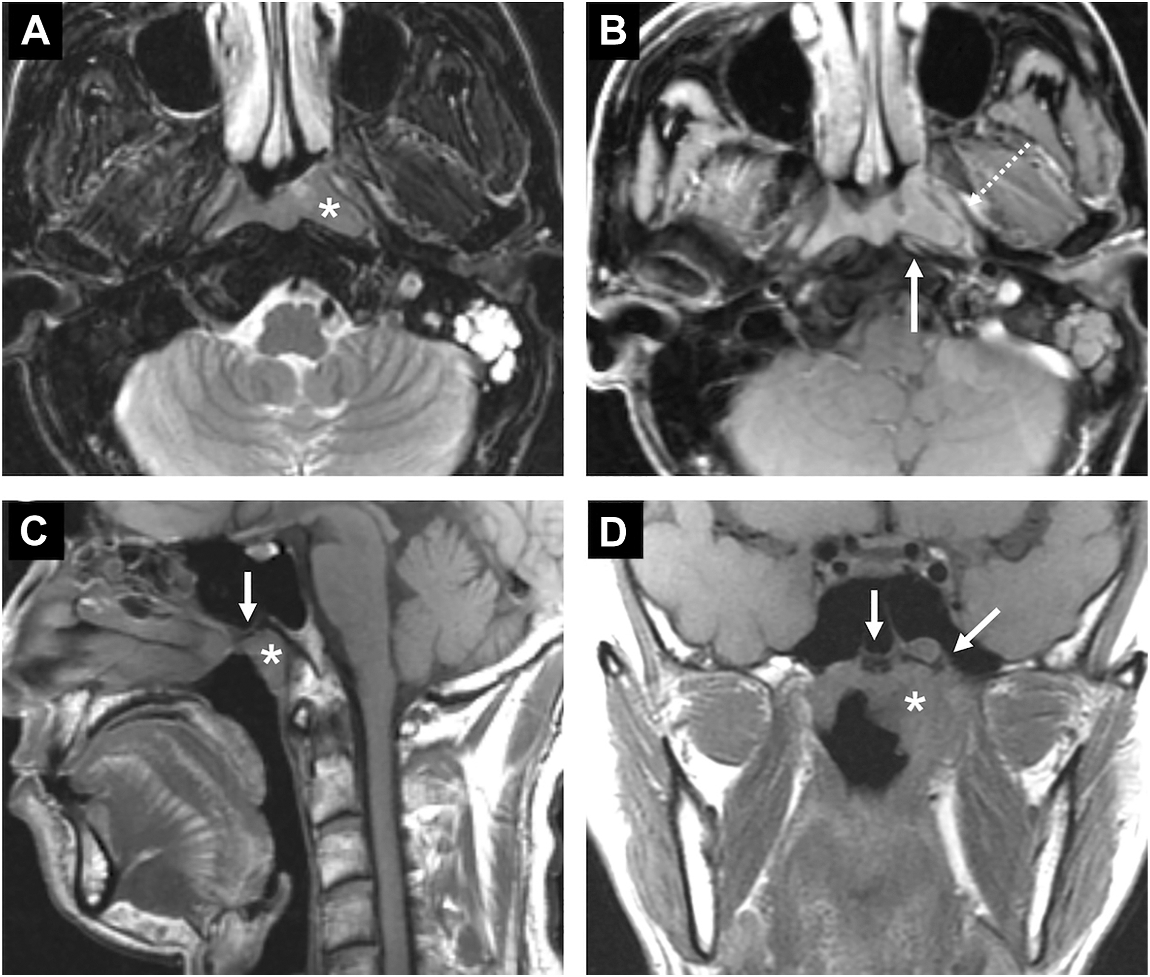 An M R I panel labeled A to D shows axial, sagittal, and coronal views of a nasopharyngeal mass marked by asterisks and arrows indicating extension and displacement.