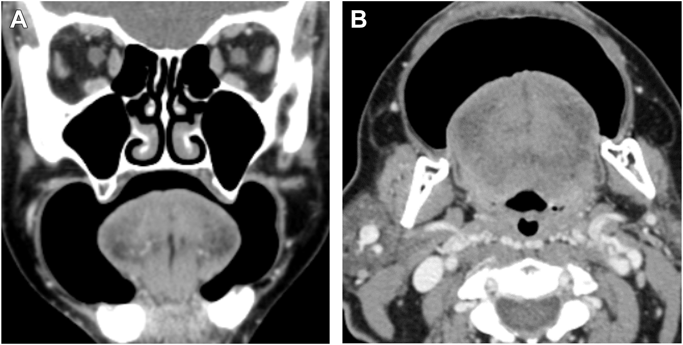 Two post-contrast C T scans depict normal buccal space and gingiva using the puffed cheek technique in coronal and axial views.