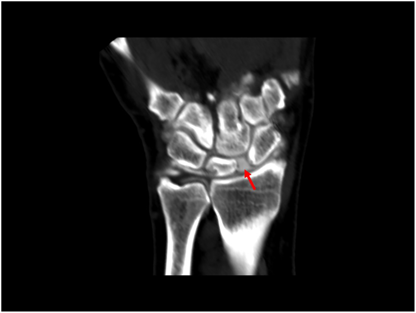 A C T scan of a wrist shows a tear between two bones.