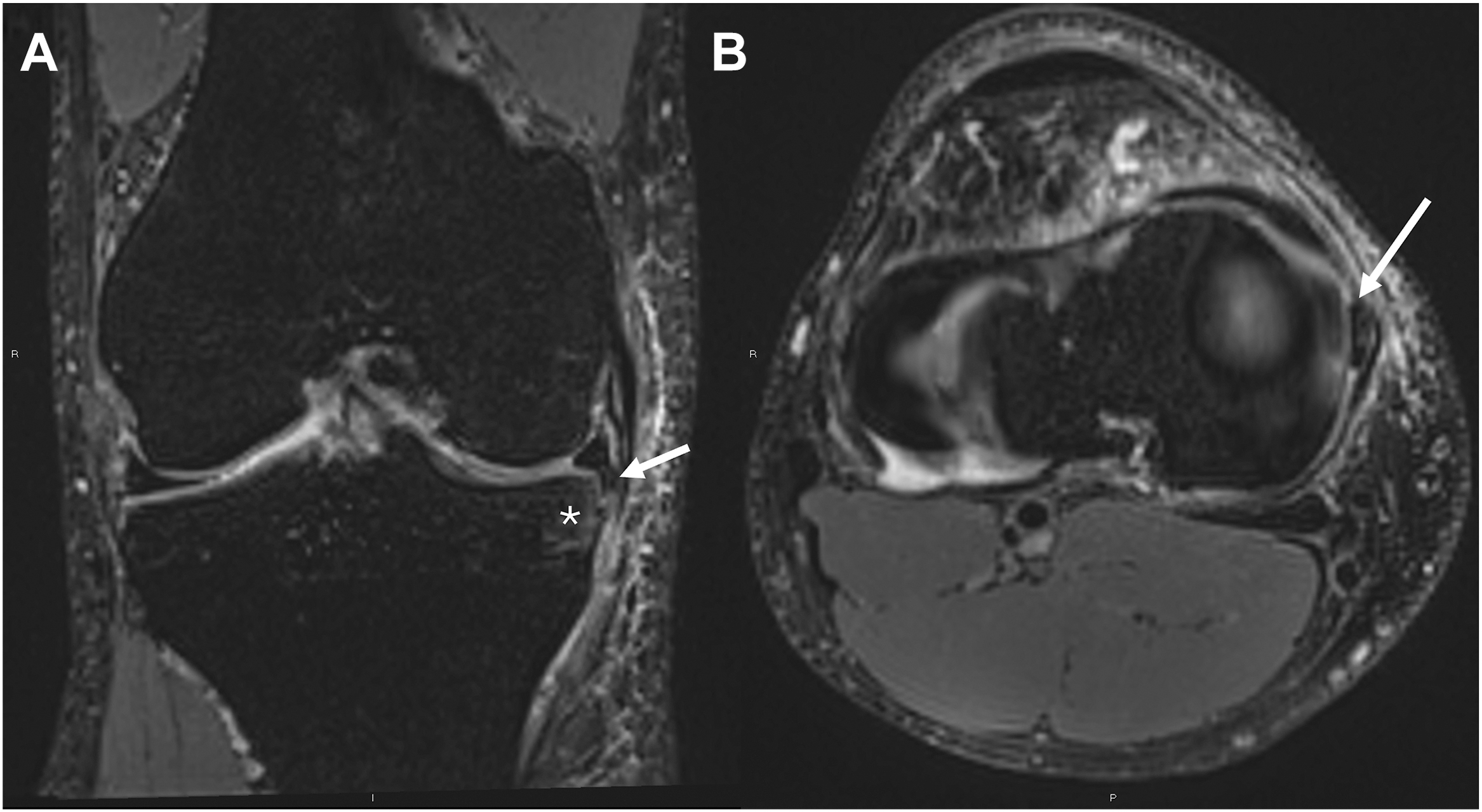 A two-panel 3 D M R I of a right knee shows a complex flap tear in the medial meniscus midbody. Arrows mark a displaced fragment, and an asterisk indicates a shiny corner sign.