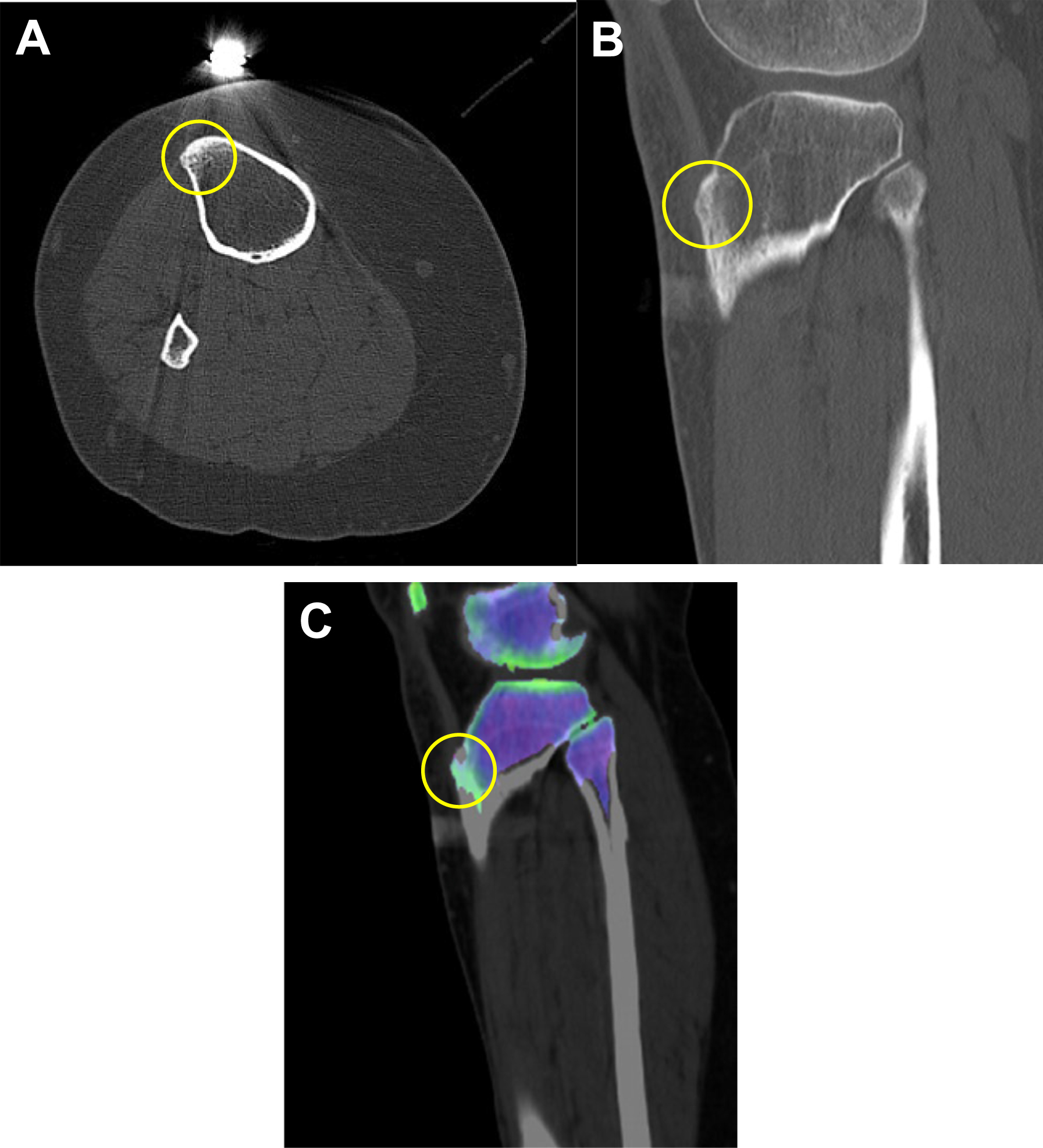 Three knee images (A-C) in a case of enthesitis.