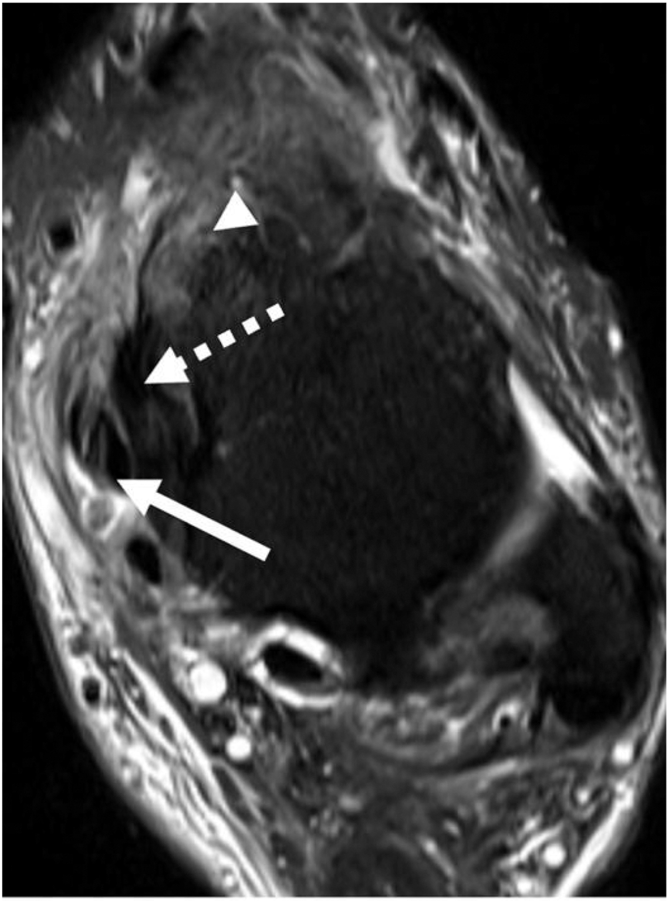 An axial P D M R I scan shows a full thickness P T T tear (arrow), a torn spring ligament (dashed arrow), and reactive bone marrow edema (arrowhead).