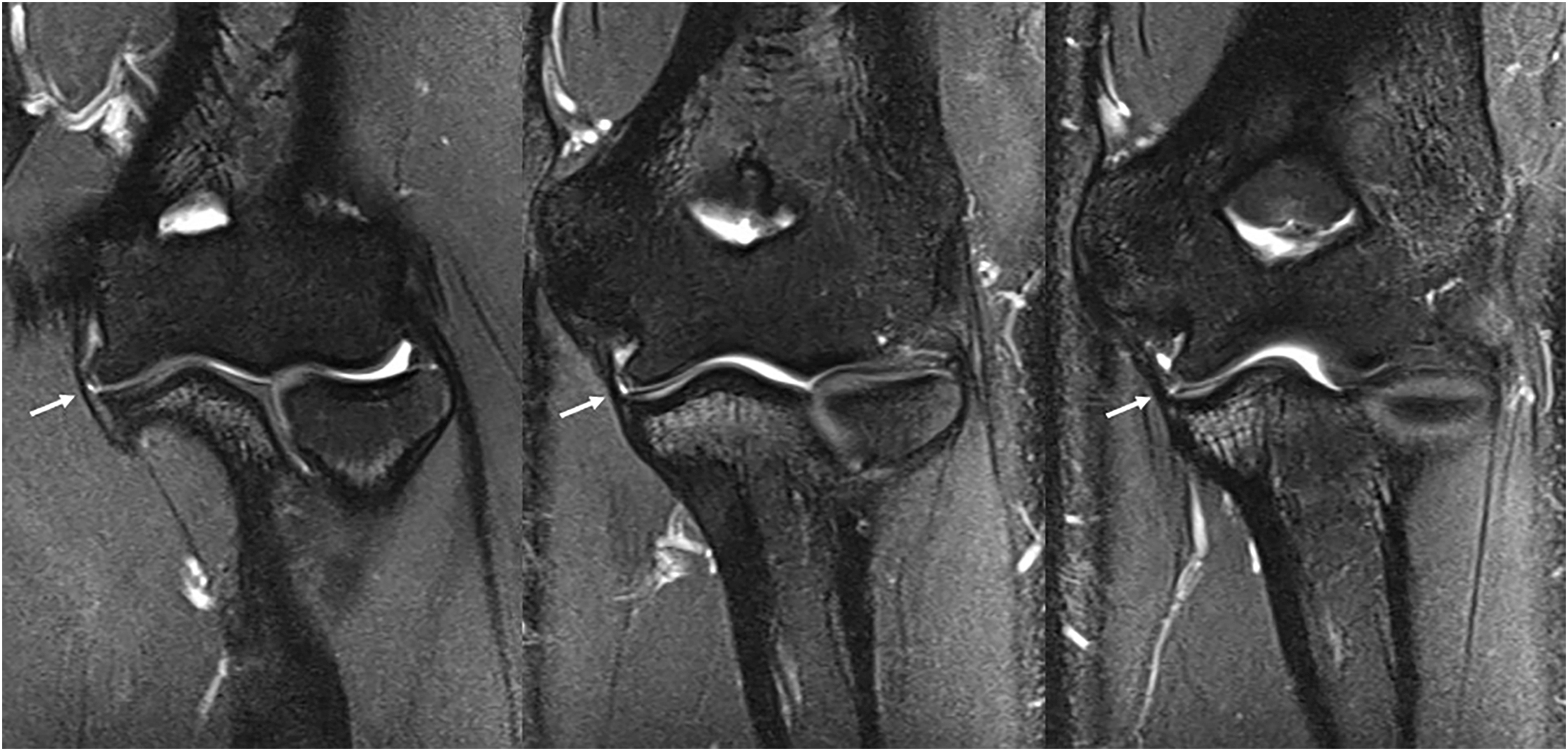 Six M R I scan in two rows show sequential coronal views of the elbow joint with arrows marking the ligament from left to right.