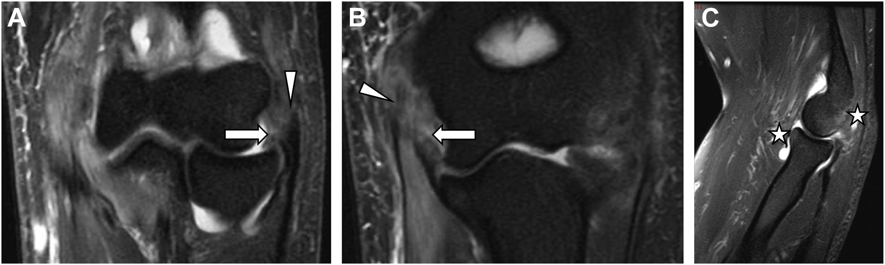 Two coronal and a sagittal elbow scan show ligament tears, tendon injury, bone bruises, and joint swelling after traumatic dislocation.