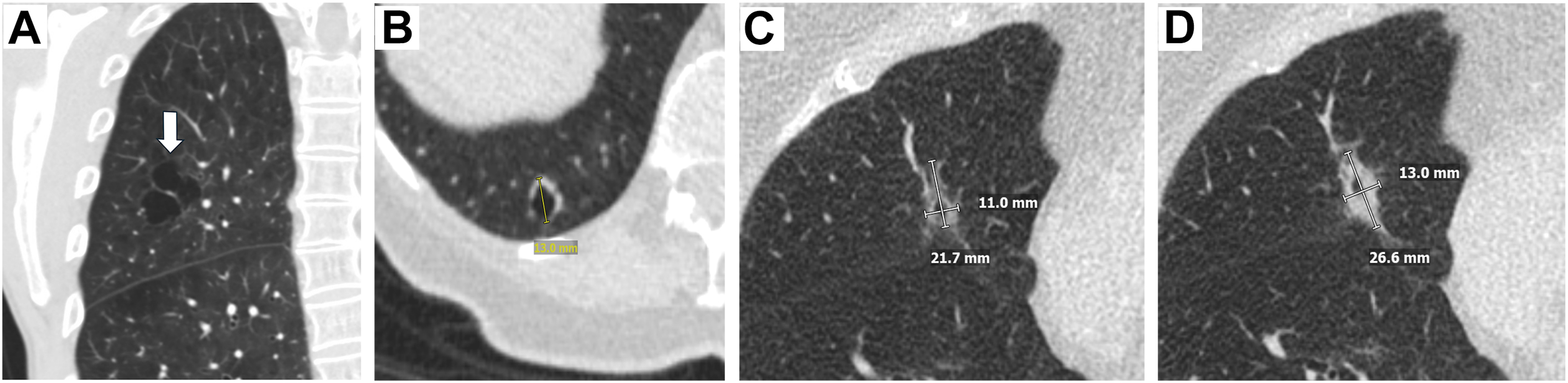 Four chest C T scans show Lung-R A D S category 4 atypical pulmonary cysts, including a multiloculated cyst, a cystic nodule with 3 millimeter wall thickening, and a cyst growing over one year.