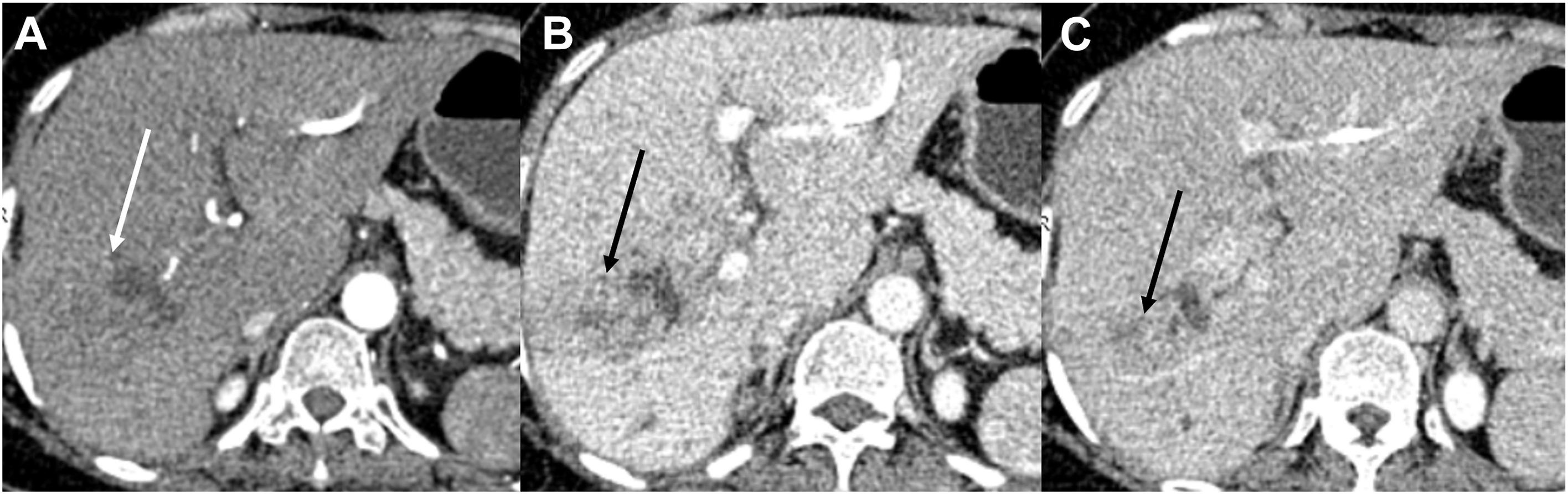 Three axial C T shows intrahepatic cholangiocarcinoma with a heterogeneous right liver lobe mass, portal venous phase delineation, a biliary drainage catheter, and progressive delayed enhancement.