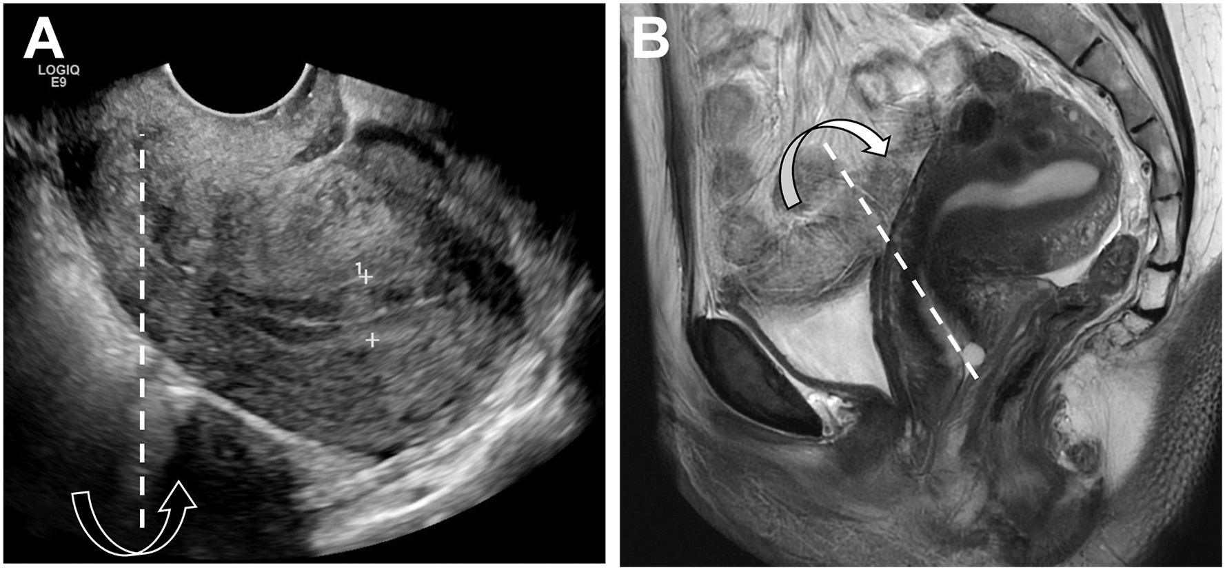 Two panels show fixed uterine retroflexion with posterior uterine tilt around the uterocervical long axis on sagittal transvaginal ultrasound and sagittal T 2-weighted M R I.