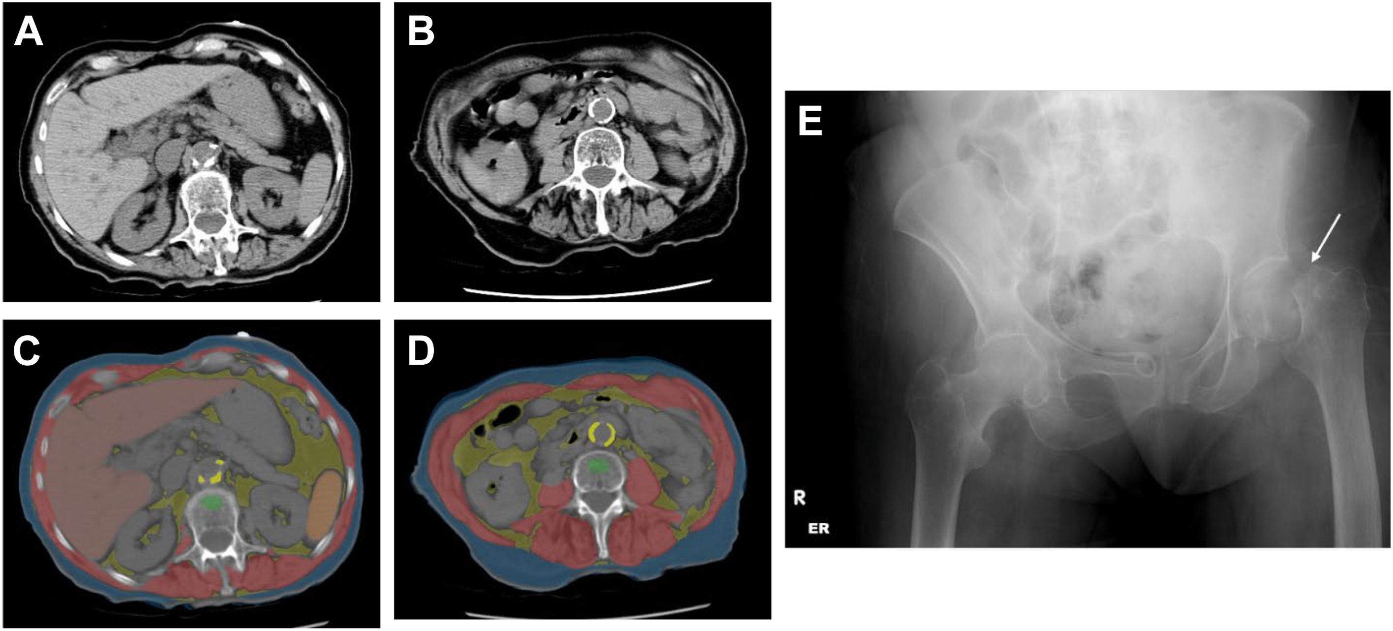 Five panels show axial C T slices with automated body composition overlays, and a later pelvic radiograph demonstrates a displaced left proximal femur fracture in an elderly woman.