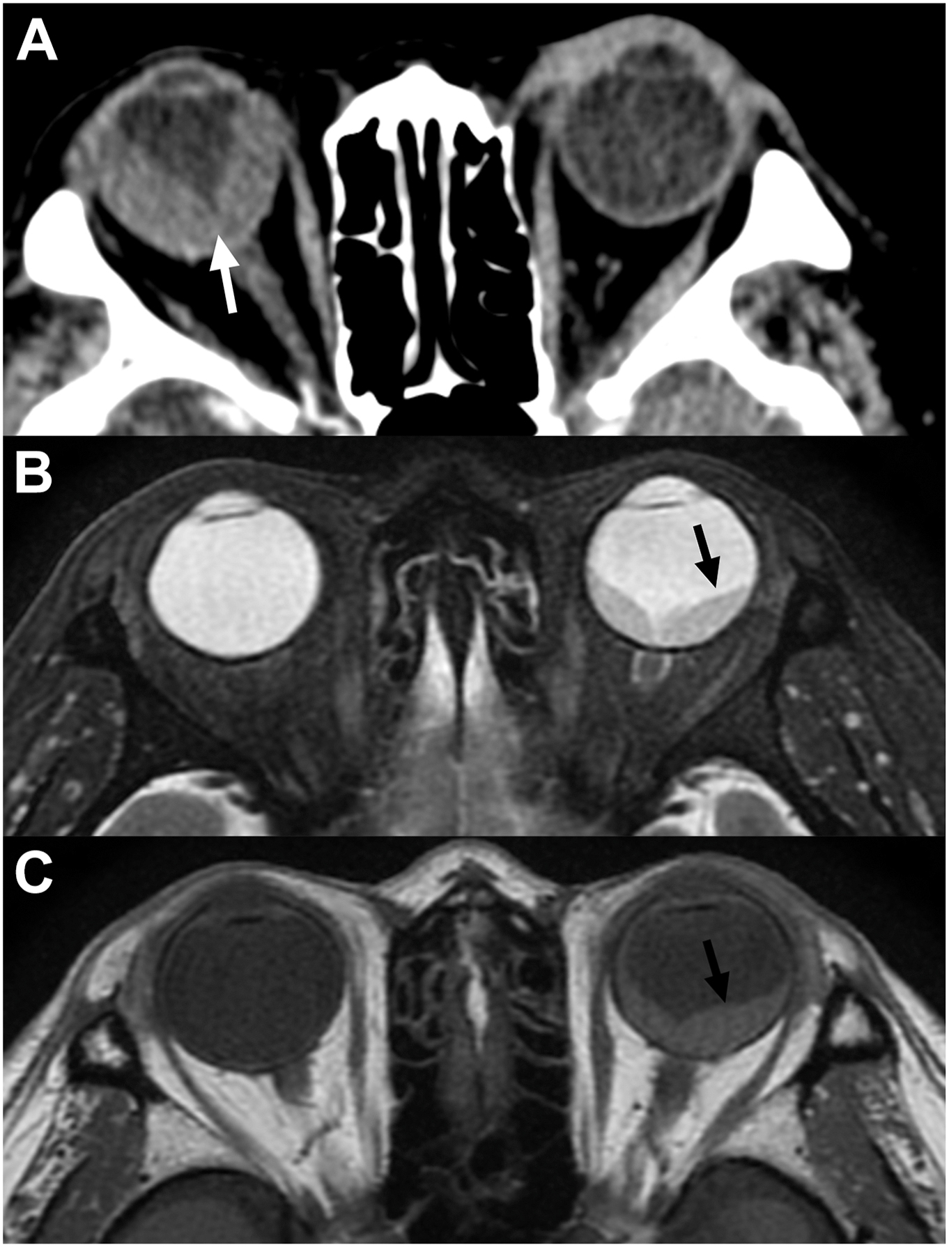 Three C T and M R I images show retinal detachment with subretinal fluid extending from the ora serrata to the optic disc, appearing hyperdense or hyperintense.