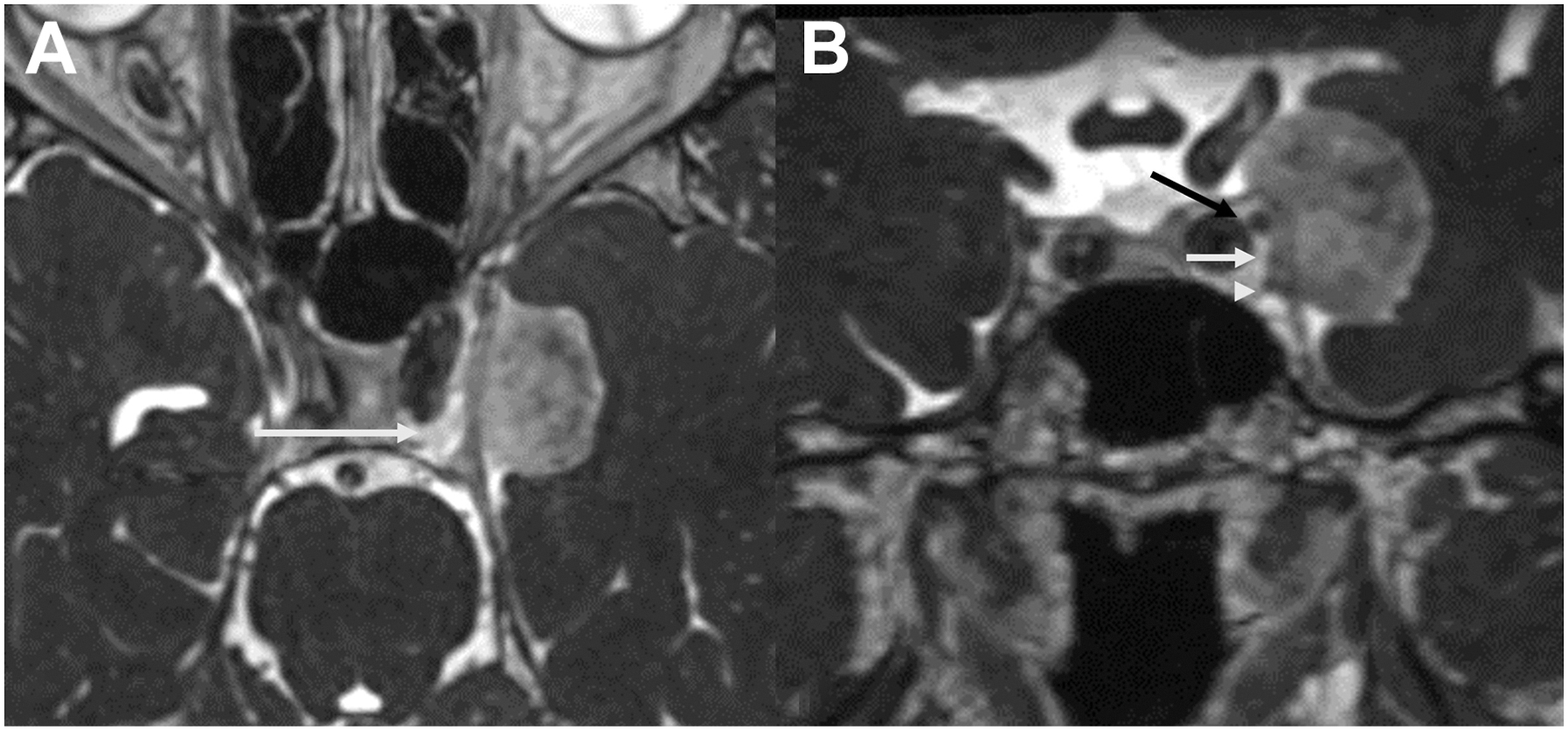 An axial and coronal contrast-enhanced C I S S M R I scans show a left lateral cavernous sinus meningioma distinct from the sinus proper and cranial nerves, indicating feasible resection.