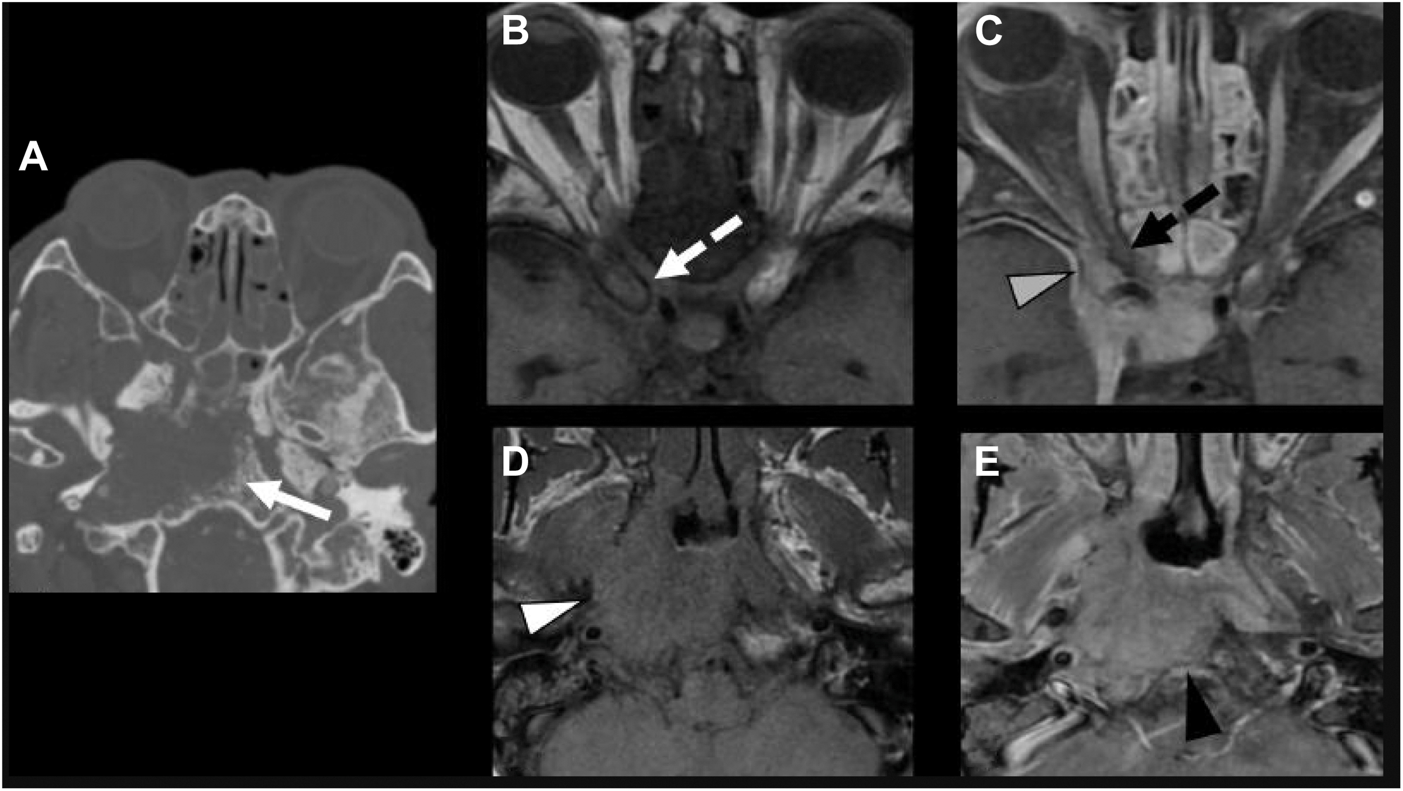 A five-panel imaging study of nasopharyngeal carcinoma shows an asymmetric nasopharyngeal mass with deep infiltration, skull base erosions, and cranial extension to the orbital apex.