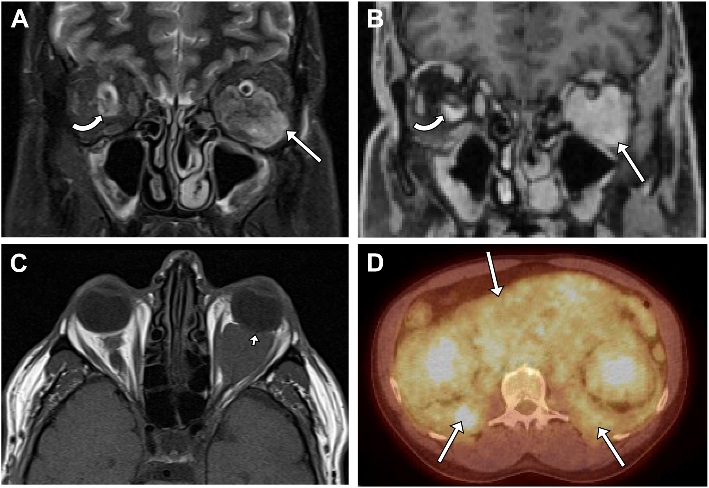 A four-panel radiological scan shows Erdheim-Chester disease featuring bilateral avidly enhancing intraorbital masses and systemic retroperitoneal infiltration on a P E T scan.