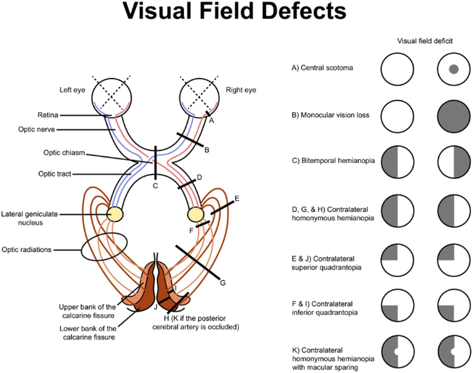 A diagram of the visual pathway mapping specific locations of injury from the optic nerve to the visual cortex to their corresponding visual field defects is shown as shaded circles.