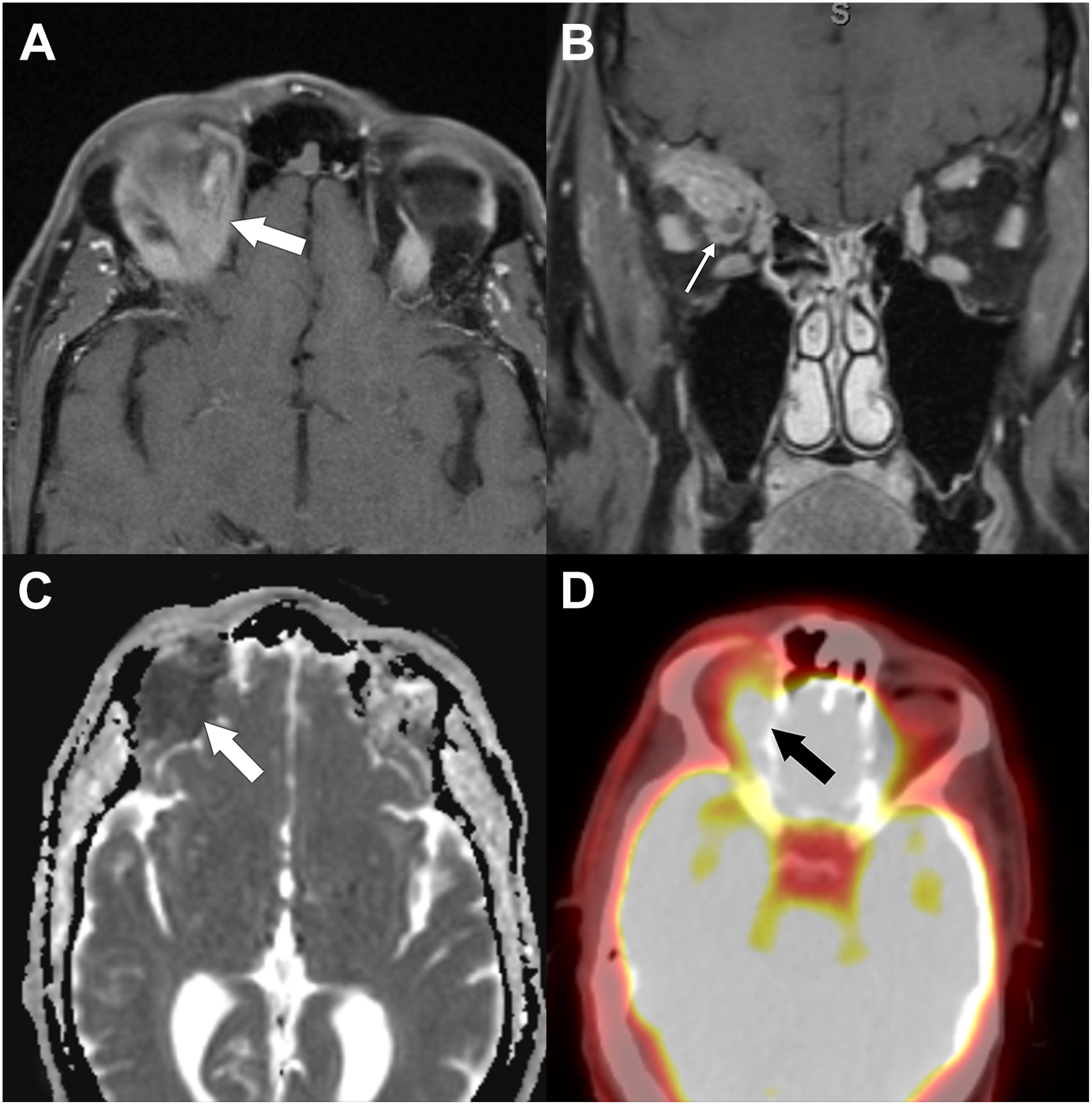 A four-part scan shows marginal zone lymphoma in the right orbit and includes axial and coronal magnetic resonance imaging, an apparent diffusion coefficient map, and a positron emission scan.