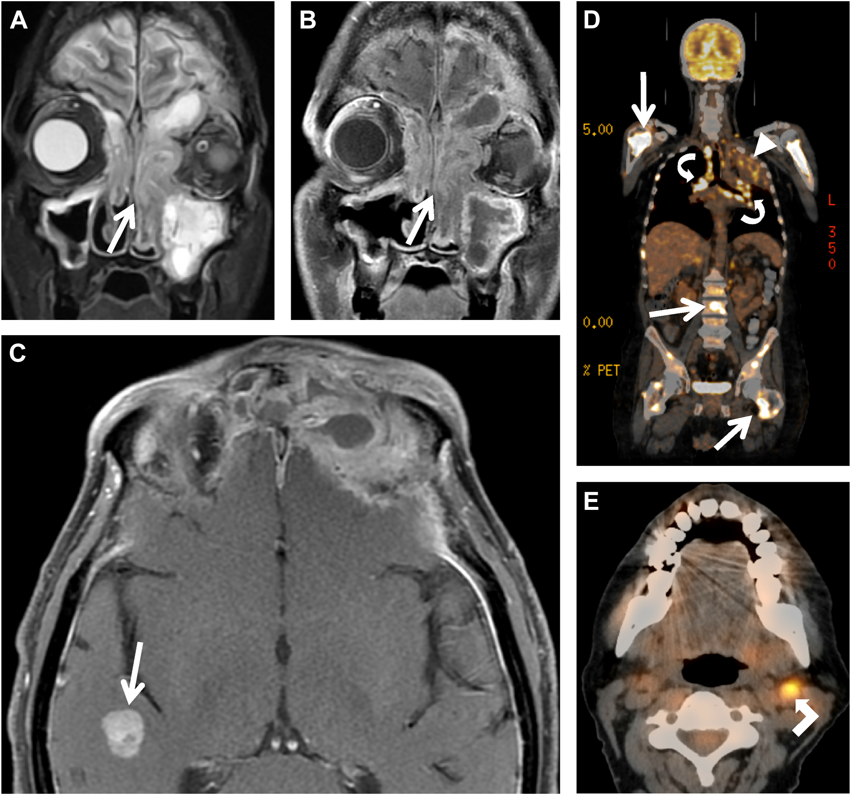 A multi-panel radiologic image shows a nasal tumor with nodal and distant metastases, including brain, lung, lymph nodes, and bone.