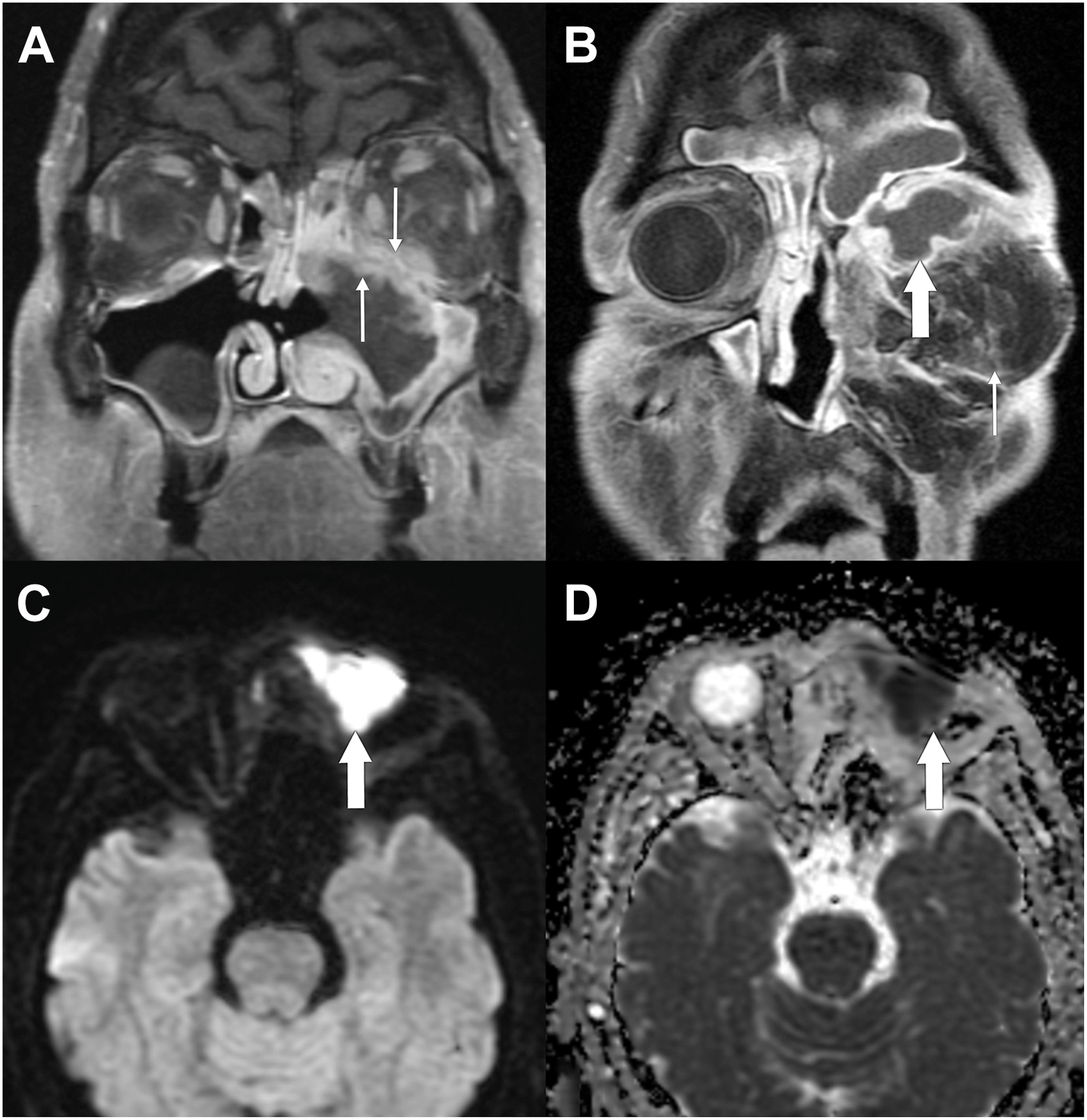 A four-panel magnetic resonance imaging scan shows a left maxillary sinus mass before surgery and the subsequent development of a restricted diffusion abscess following an orbital exenteration.