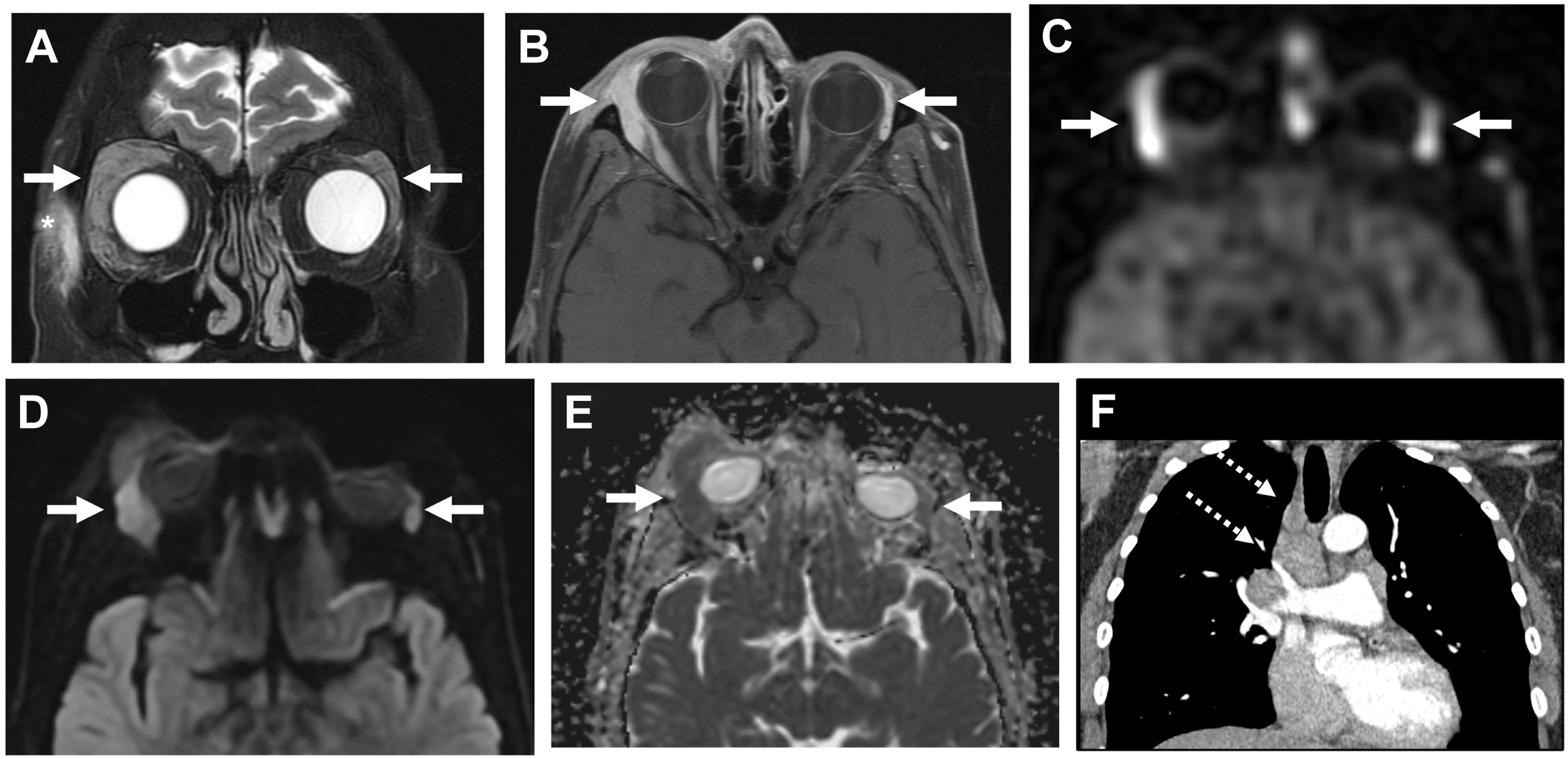 A six-panel scan of a 65-year-old female with sarcoidosis shows asymmetrically enlarged and enhancing bilateral lacrimal glands alongside a chest scan displaying affected lymph nodes.