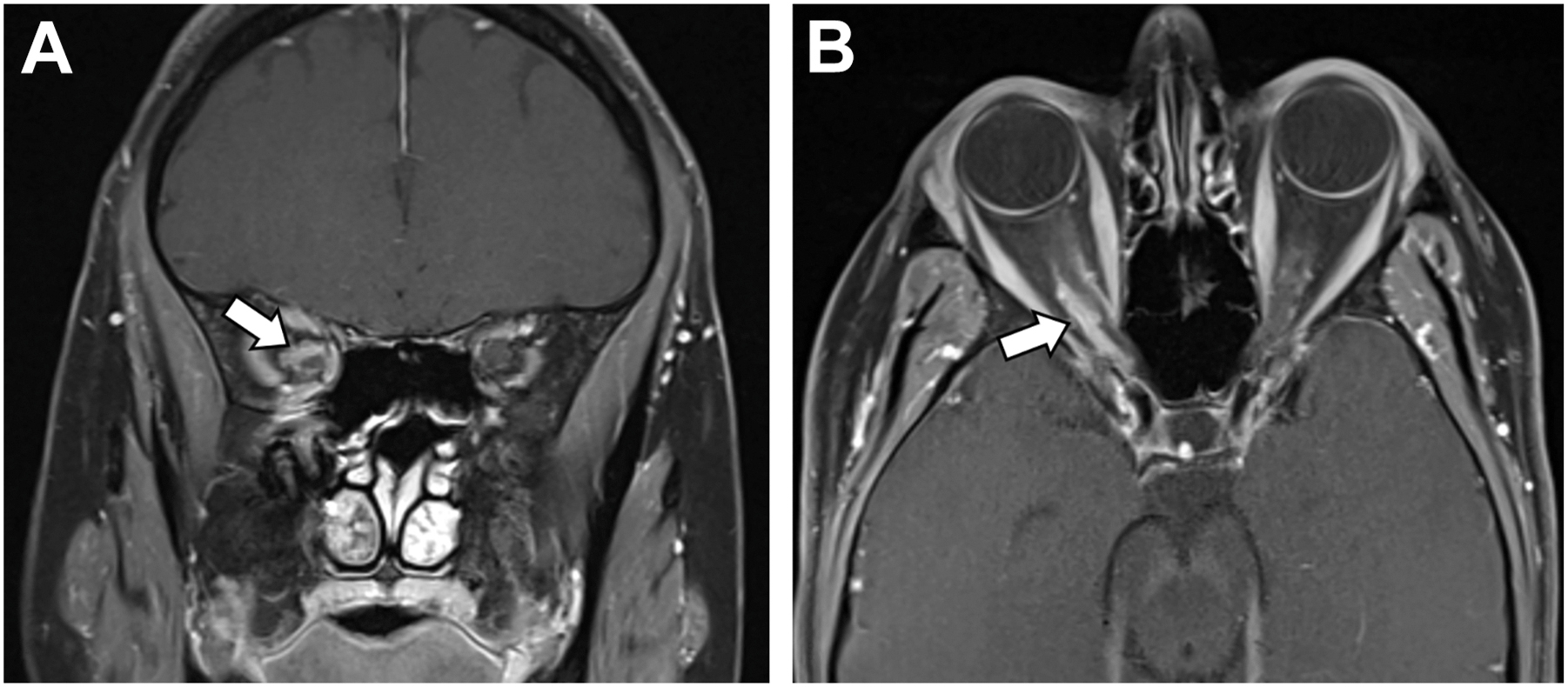Two postcontrast T 1-weighted M R I scans, A and B, illustrating an optic nerve sheath meningioma.