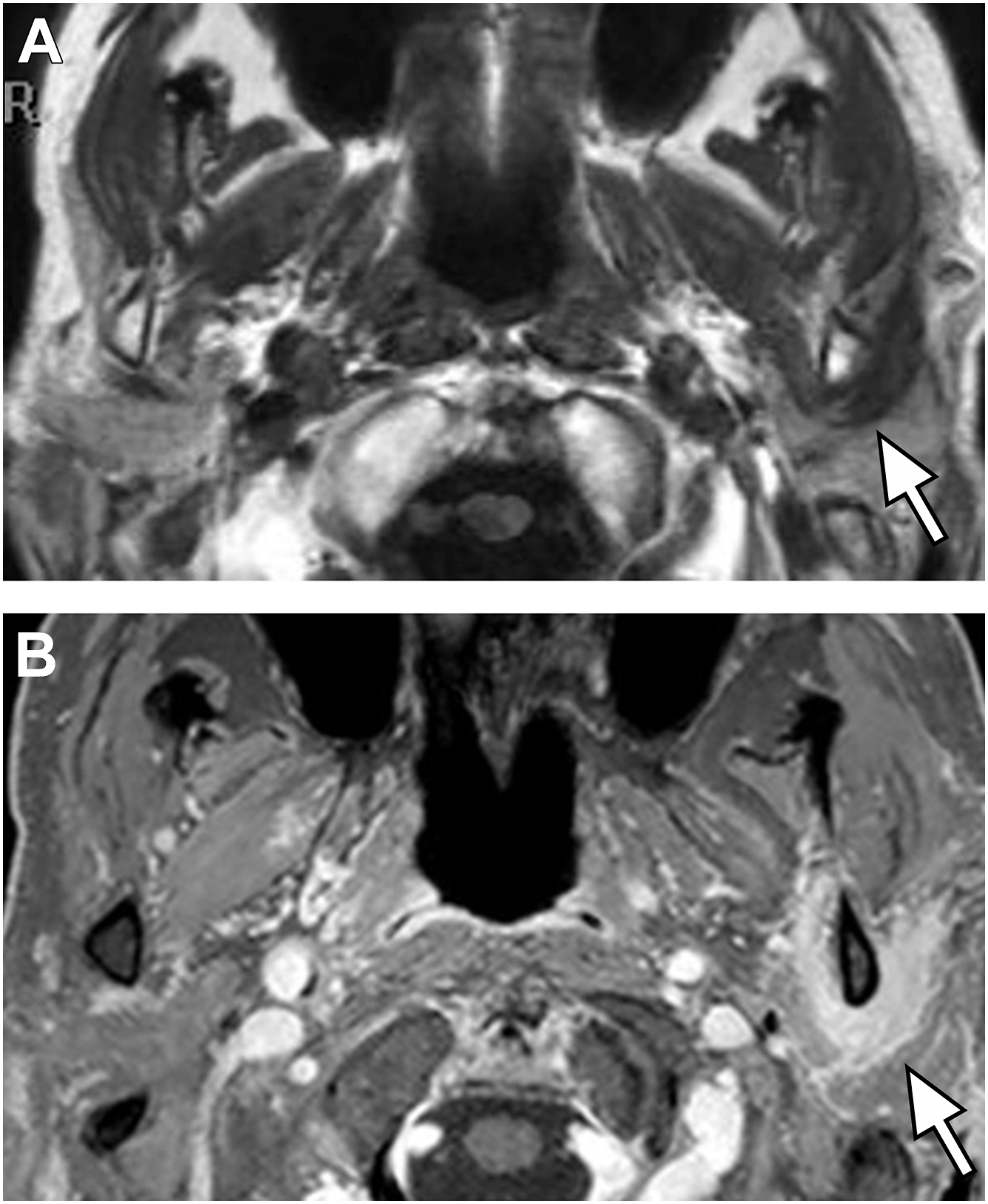A pair of axial M R I scan sections presents the head and upper neck, each with an arrow marking an abnormal area on the right side near the jaw.