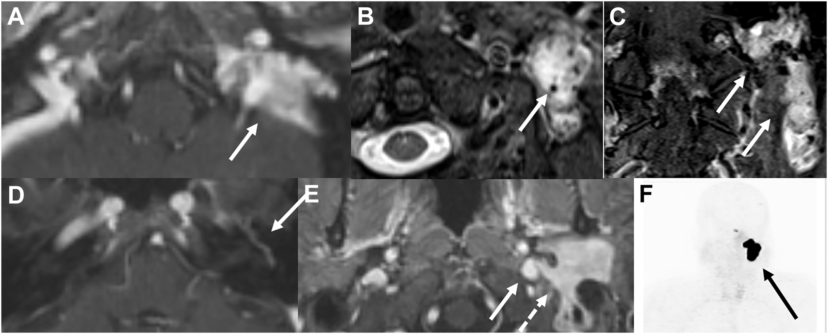 A series of six scans shows an enhancing lesion near the jugular bulb with internal flows.