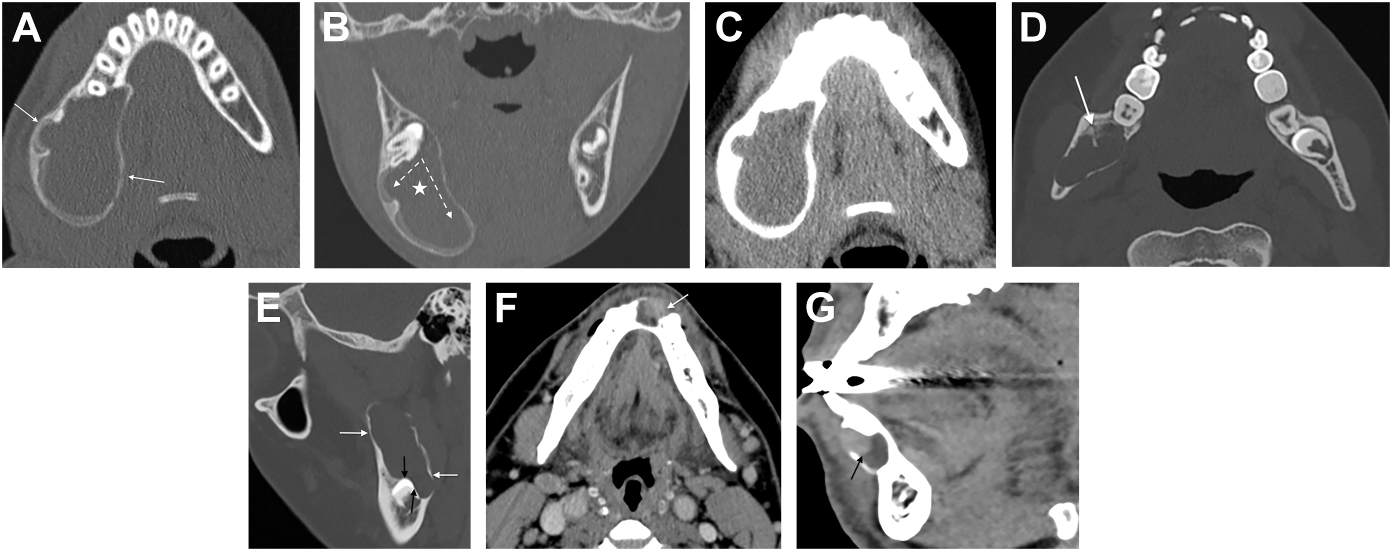 Six computed tomography scans show mandibular symphysis lesions with mural nodules in cystic structures demonstrating enhanced soft tissue components.
