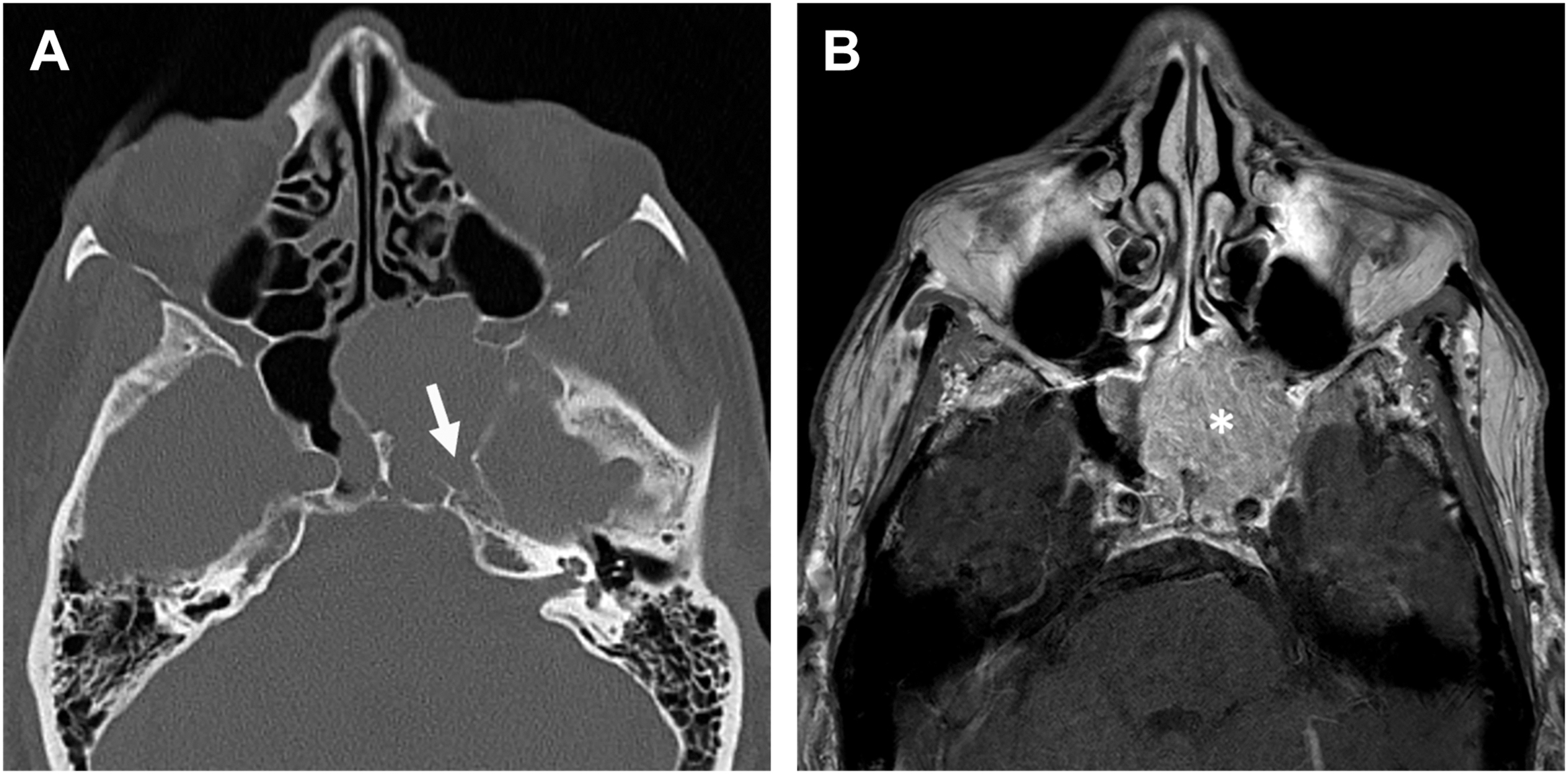 An axial CT and MRI scan pair displays a destructive sphenoid sinus with arrow and asterisk markers indicating the lesion extends into adjacent anatomical areas.