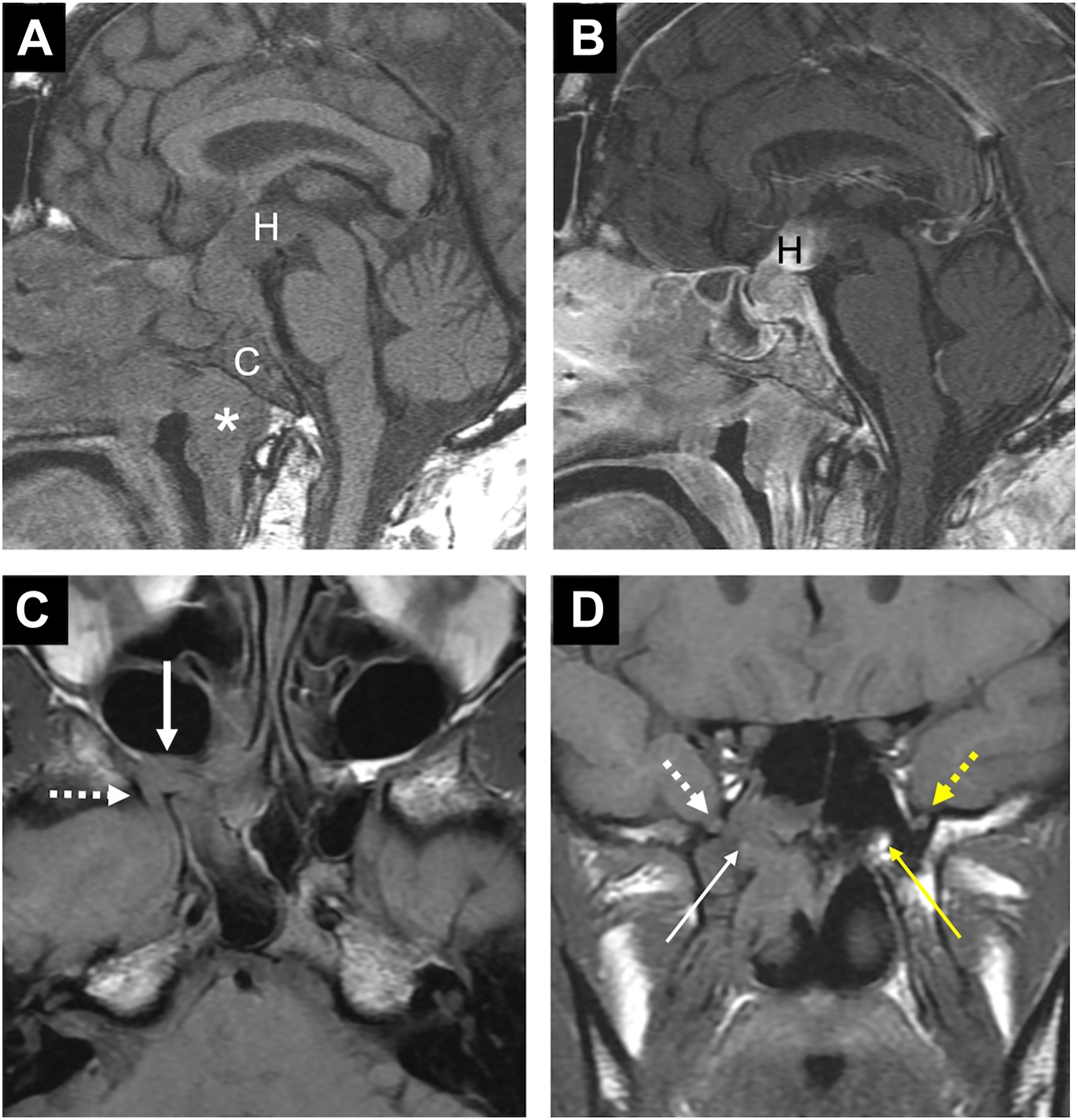 A set of four sagittal and coronal brain MRIs labeled A to D, highlighting the hypothalamus, cavernous sinus, and other structures with arrows, asterisks, and annotations for pathology evaluation.