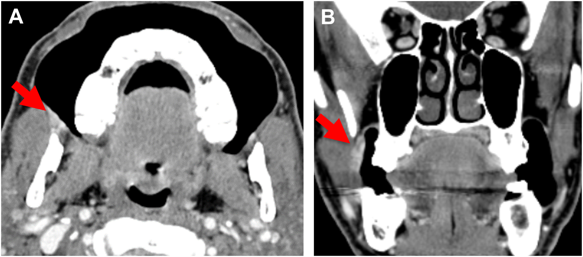 A post-contrast C T scan with puffed cheek technique depicts right buccal mucosa S C C on axial and coronal views, enhancing visualization of the lesion.