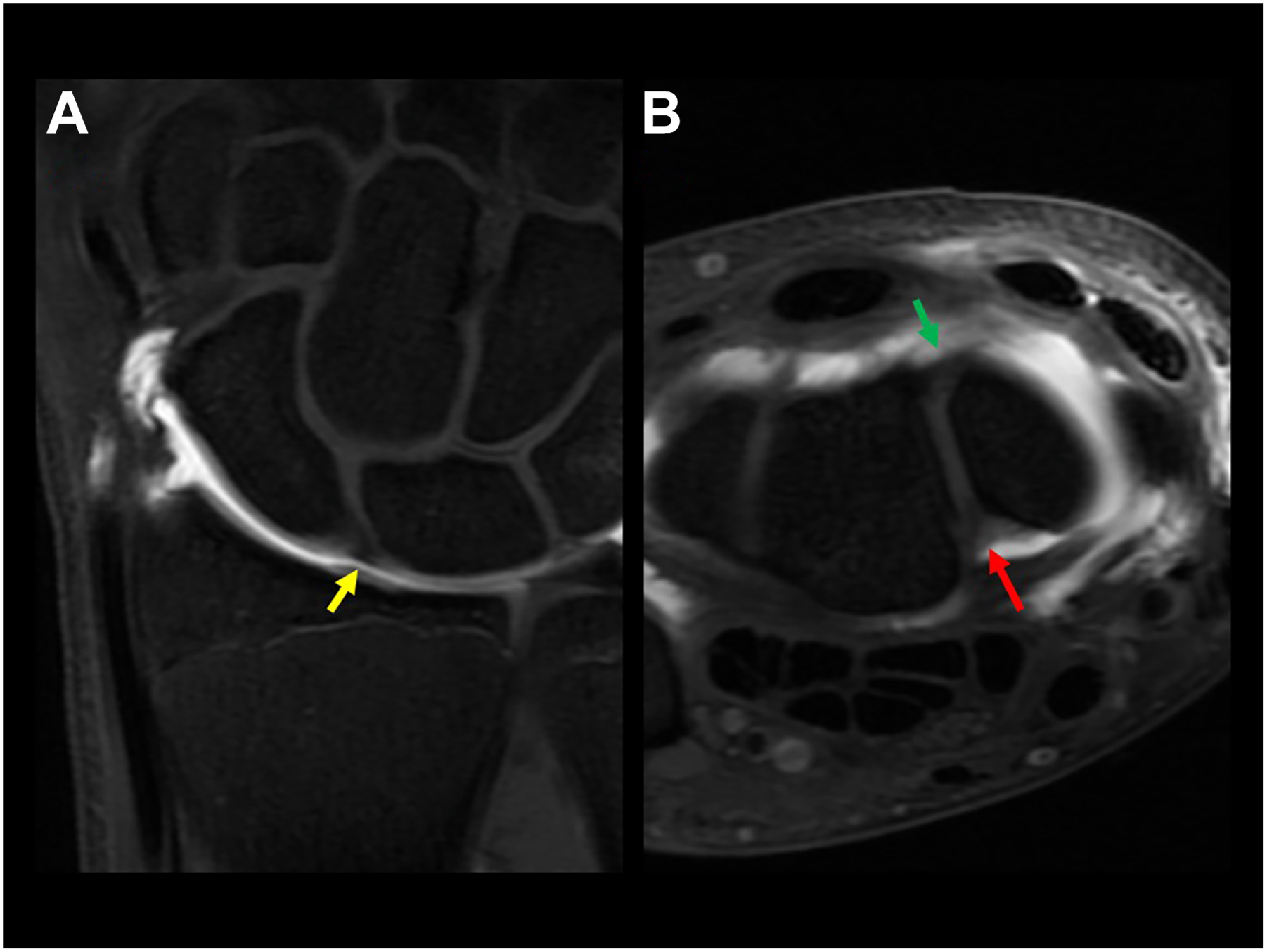 Two M R I scans of a wrist show a normal ligament in a coronal and axial view.