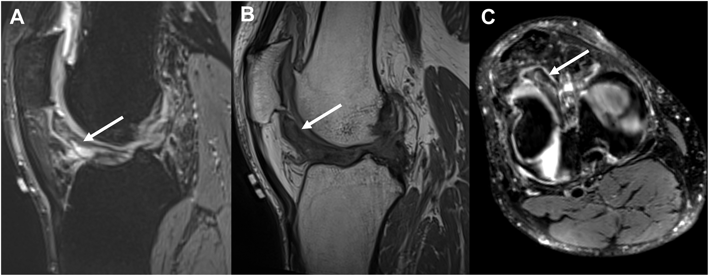 A three-panel 3 D M R I of a left knee shows a large displaced lateral meniscus. Panels A and B are sagittal views, and panel C is an axial oblique view, with arrows marking the displaced fragment.