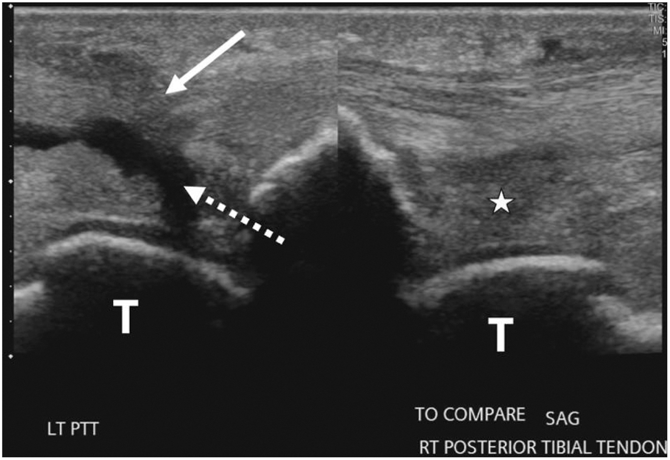 A set of two sagittal ultrasound scans compares a full thickness spring ligament tear on the left (arrows) to the intact right side (asterisk). Both scans are labeled T for talar head.