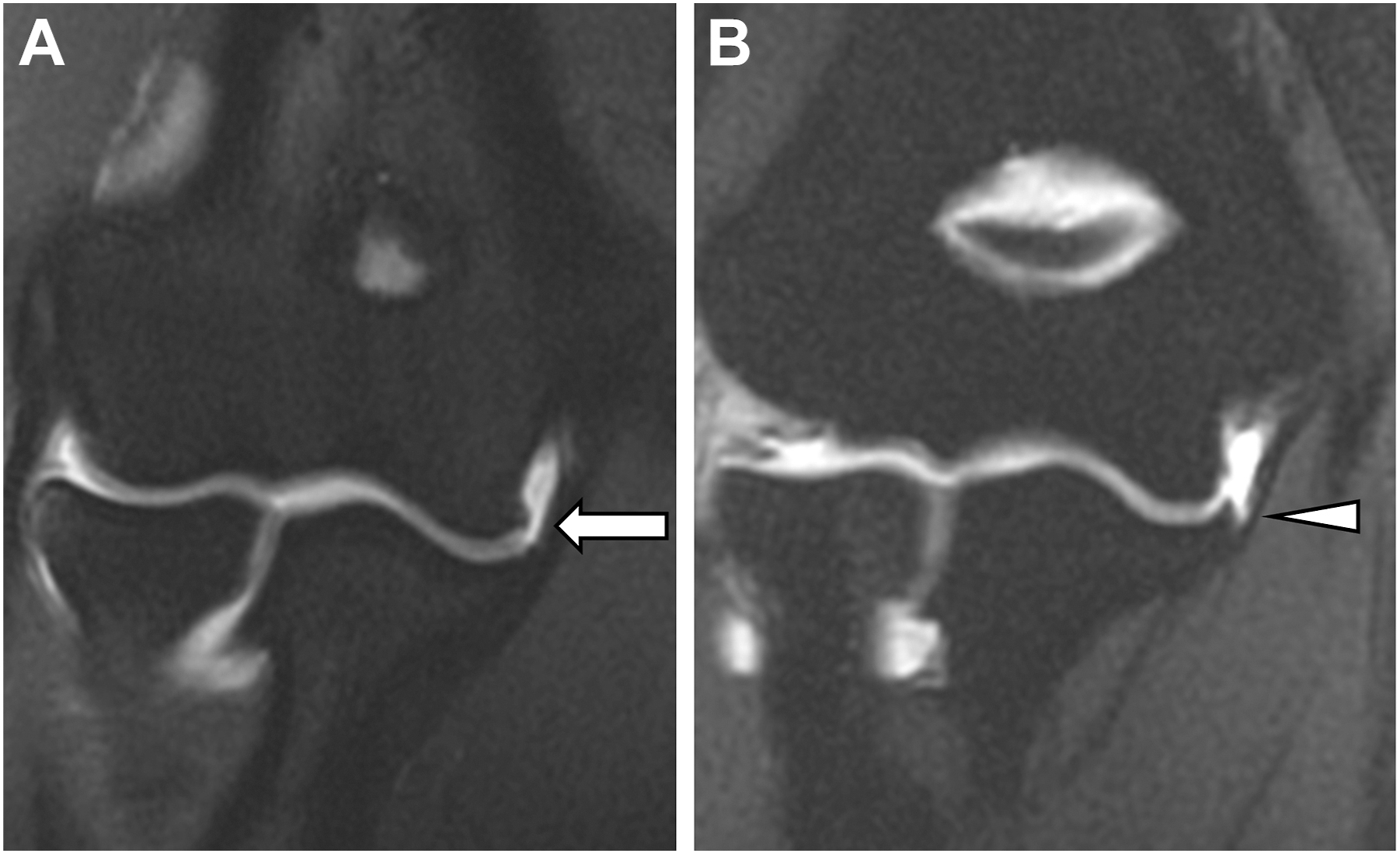 Two coronal elbow scans show normal joint contrast on one side and abnormal fluid tracking on the other, suggesting partial ligament injury.