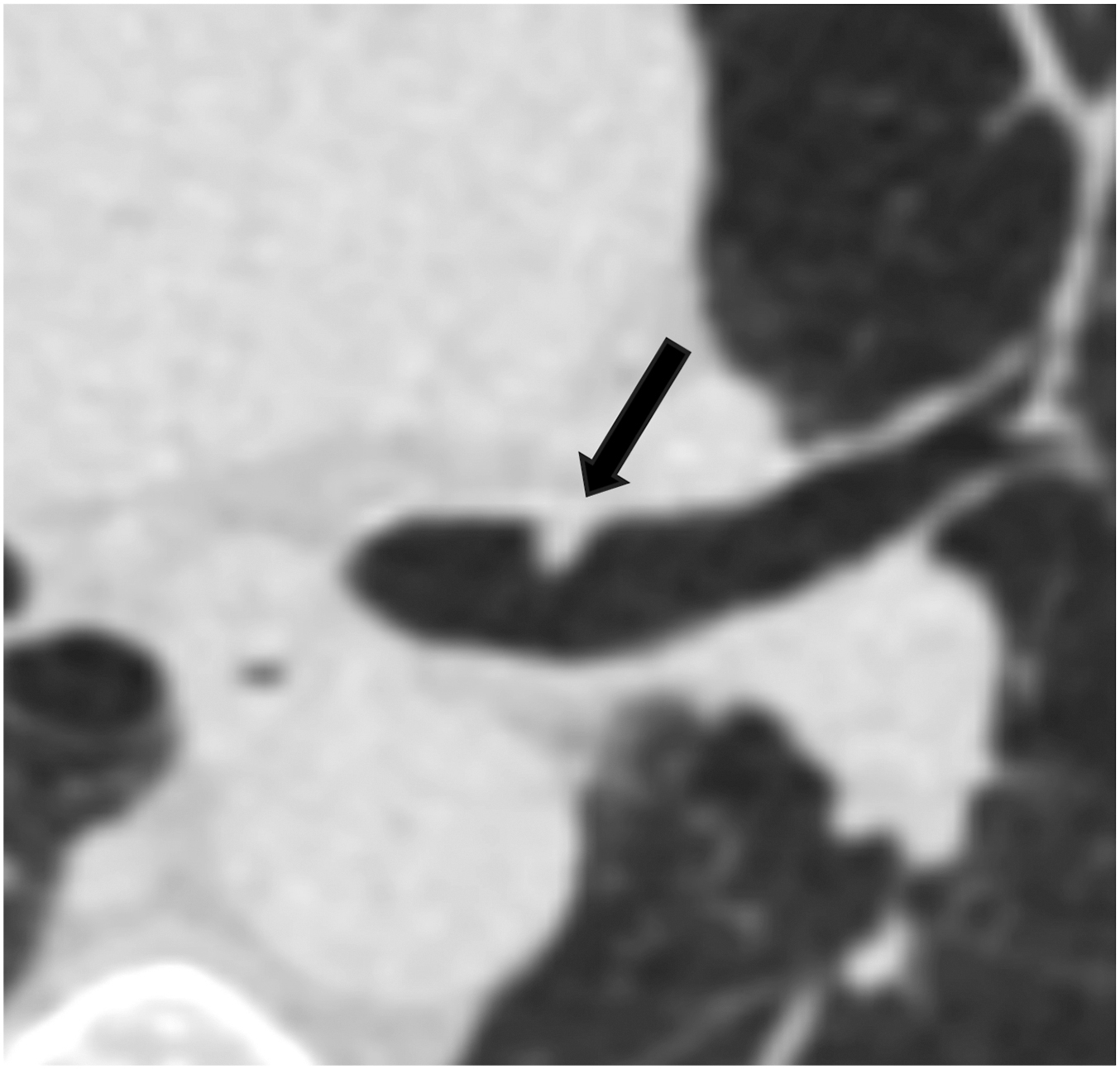 A lung-R A D S category 4A axial unenhanced chest C T scan in lung window shows a 5 millimeter polypoid nodule in the left mainstem bronchus, indicated by an arrow.