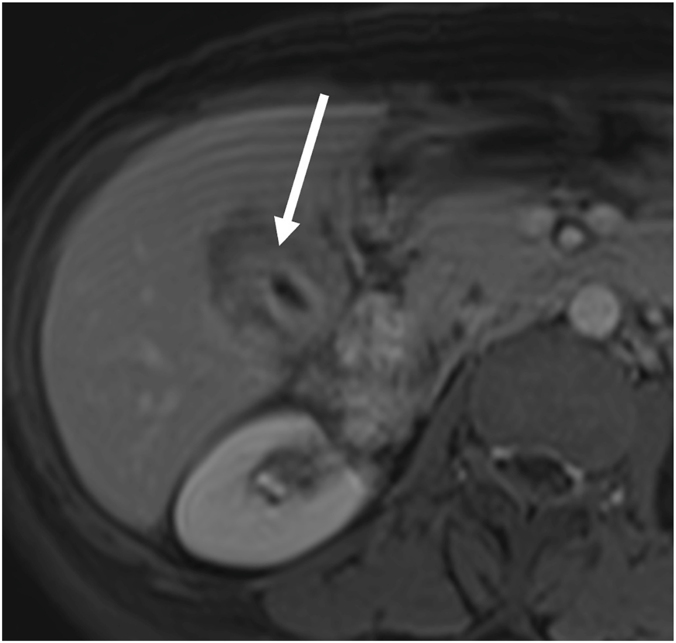An axial post-contrast M R I shows early gallbladder cancer with diffuse asymmetric mural thickening, heterogeneous enhancement, and a thick enhancing inner layer without definite liver invasion