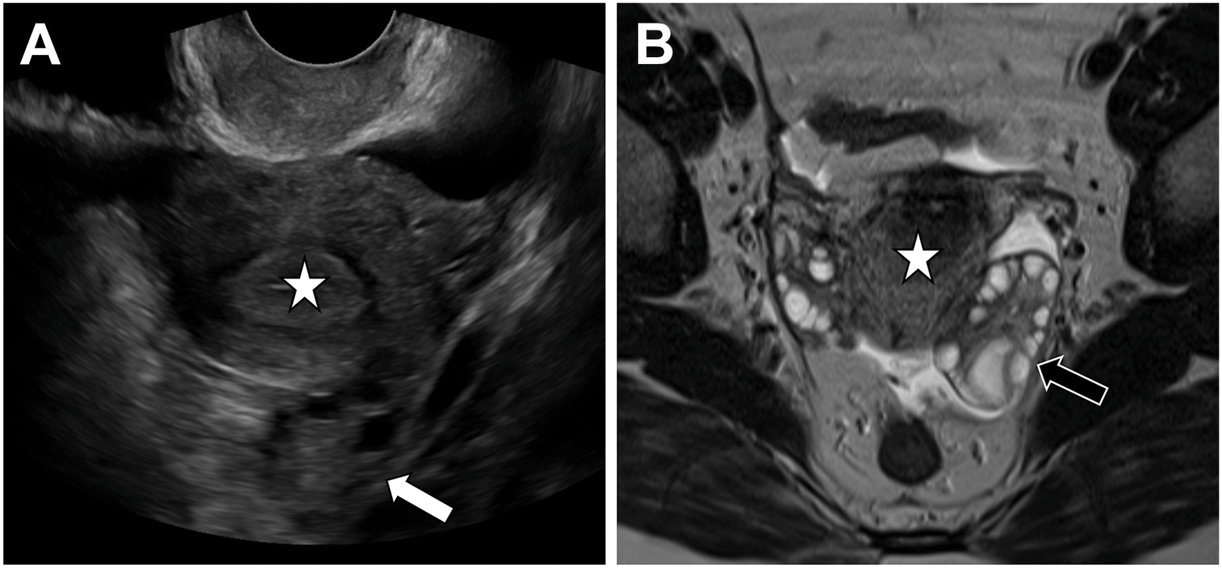 Two panels show a posteriorly located left ovary on transvaginal ultrasound and a retropositioned left ovary on axial T 2-weighted M R I, with the uterus marked by a star.