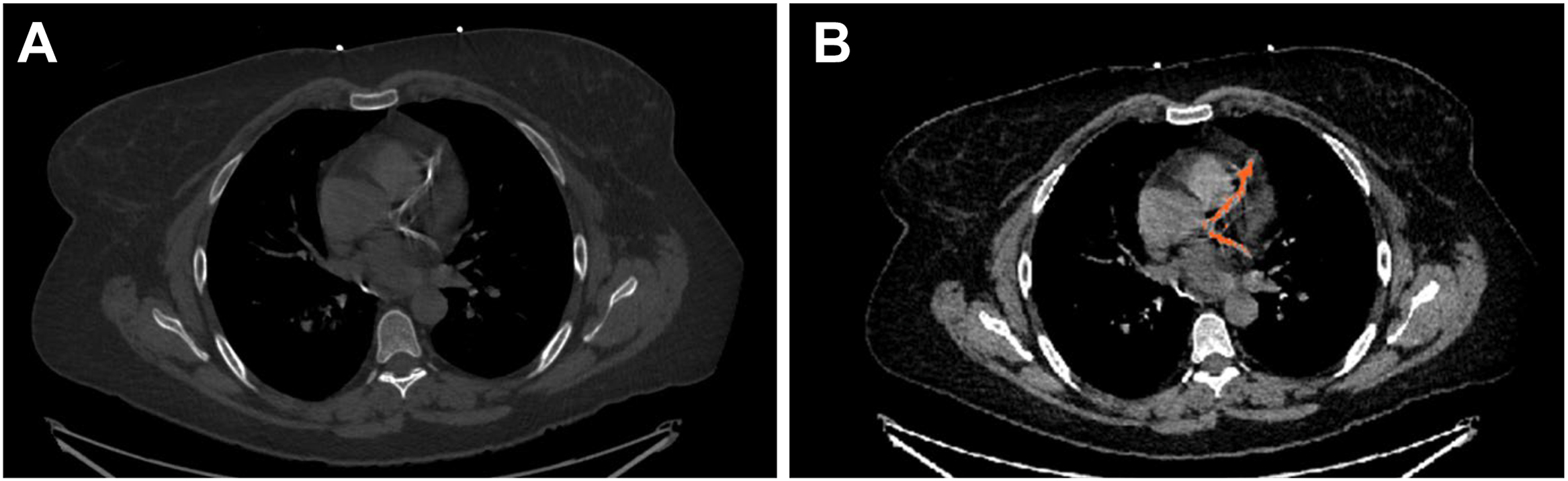 Two panels with axial C T images of the chest showing extensive coronary artery calcifications in a 42-year-old patient, highlighted by an automated A I tool to show vascular calcification.