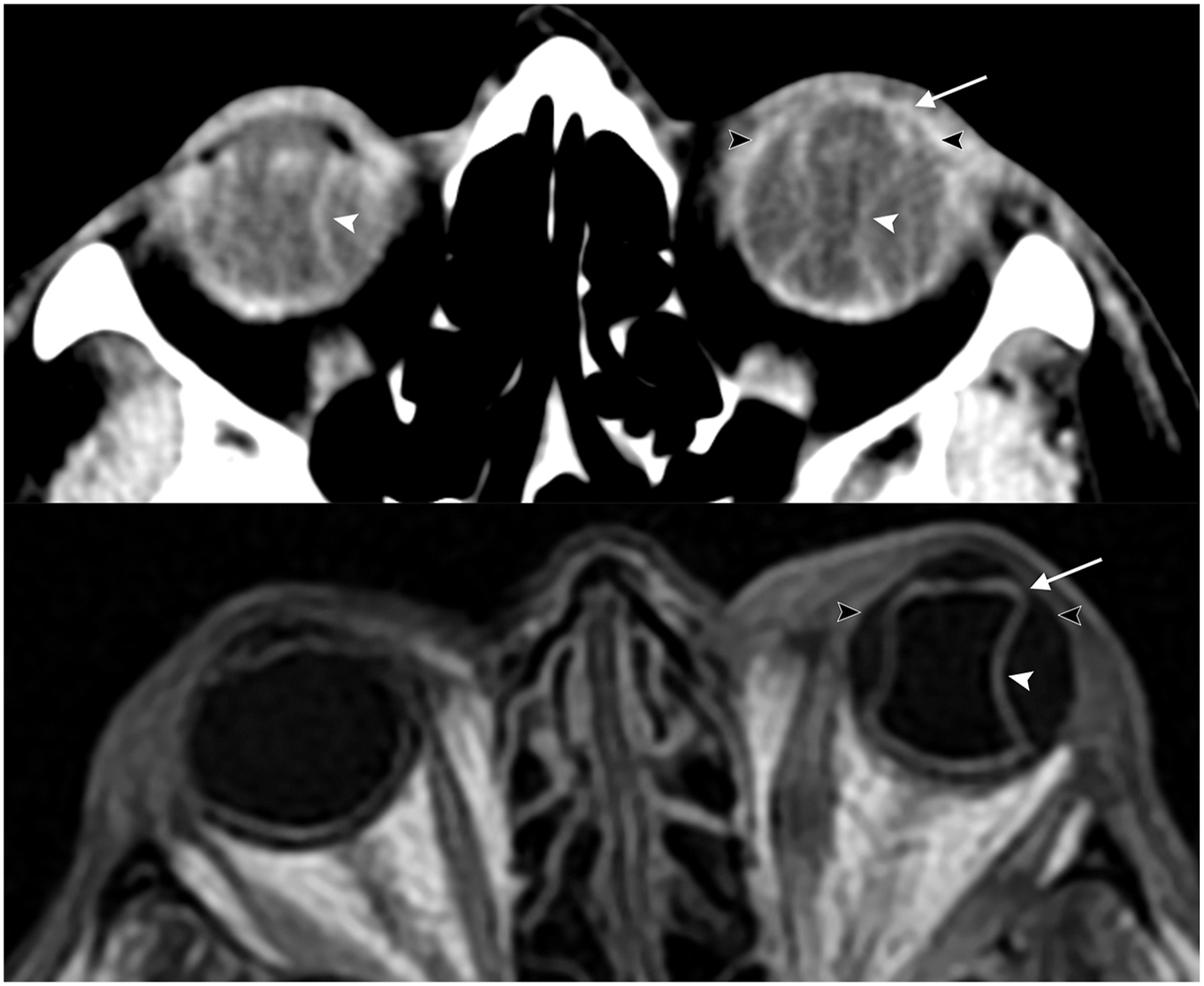 Two C T and M R I images show biconvex choroidal detachments extending to the ciliary body, bilateral on C T and left-sided on M R I.