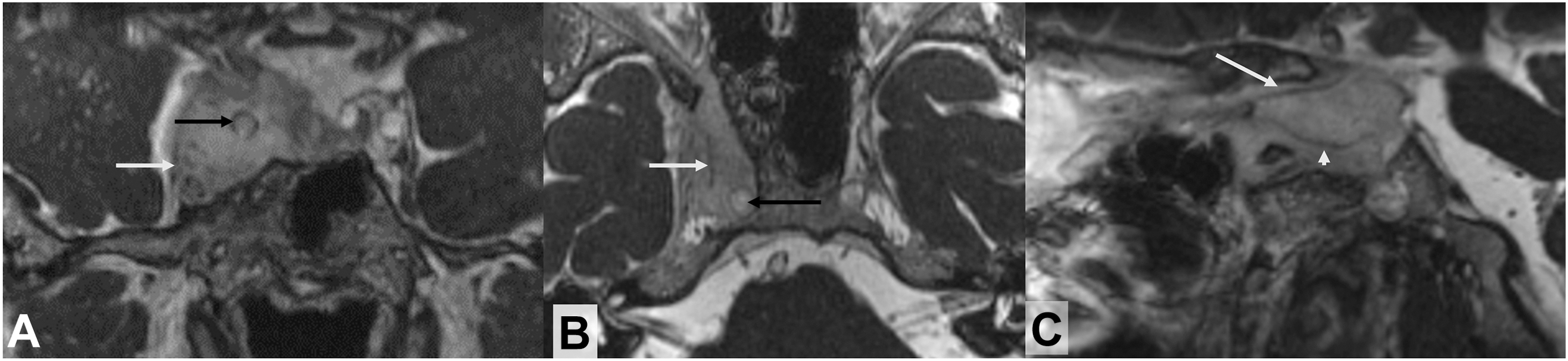 A three-panel coronal, axial, and sagittal C I S S M R I show a right cavernous sinus meningioma encasing the internal carotid artery and engulfing cranial nerves.