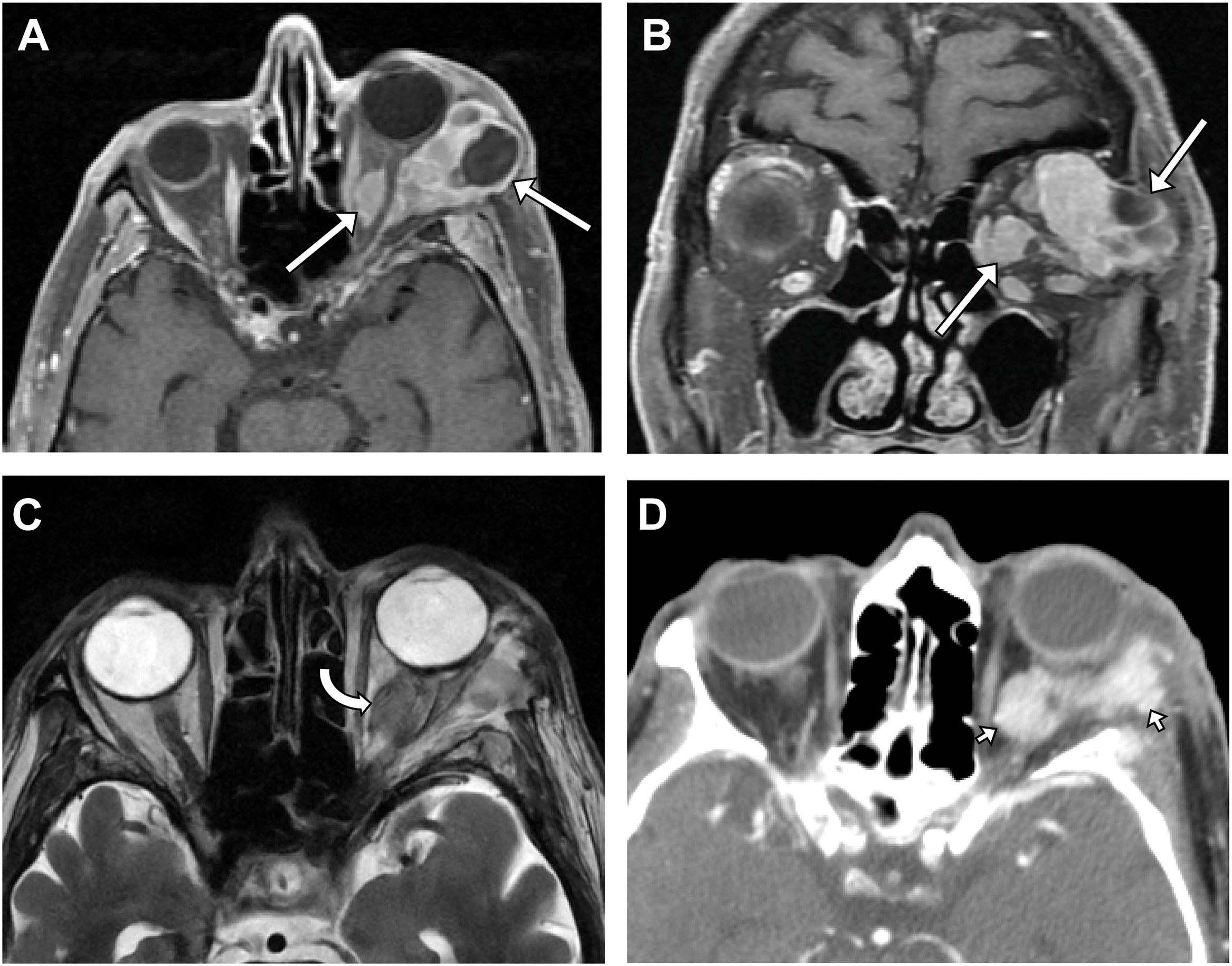 A set of magnetic resonance and computed tomography scans illustrates a lobulated, heterogeneously enhancing solitary fibrous tumor extending from intraconal to extraconal tissue planes.