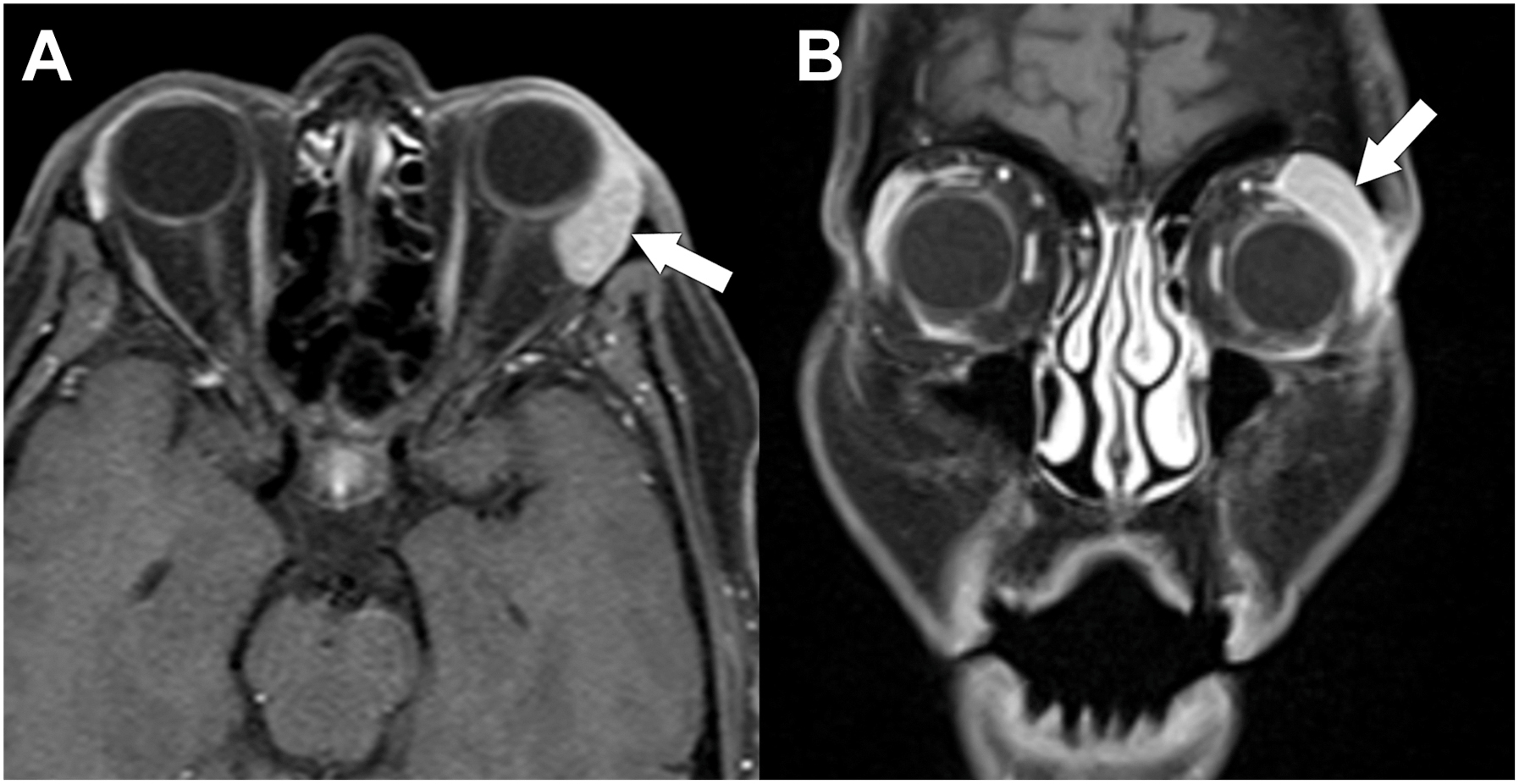 A two-part magnetic resonance imaging scan shows a grade one follicular lymphoma in the left lacrimal gland, with arrows pointing to an enhancing mass molding to the orbital wall.