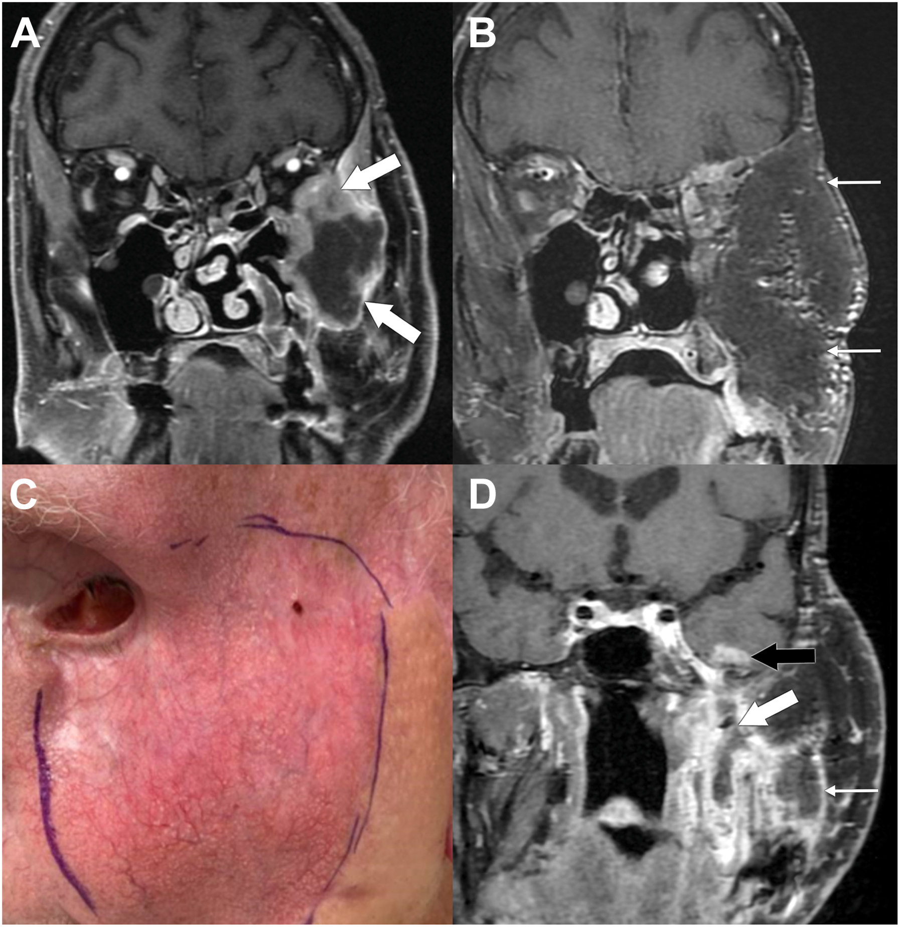 A set of three magnetic resonance imaging scans and a clinical photo shows an orbital carcinoma, a reconstructive facial flap, swelling, and an abscess with radiation necrosis.