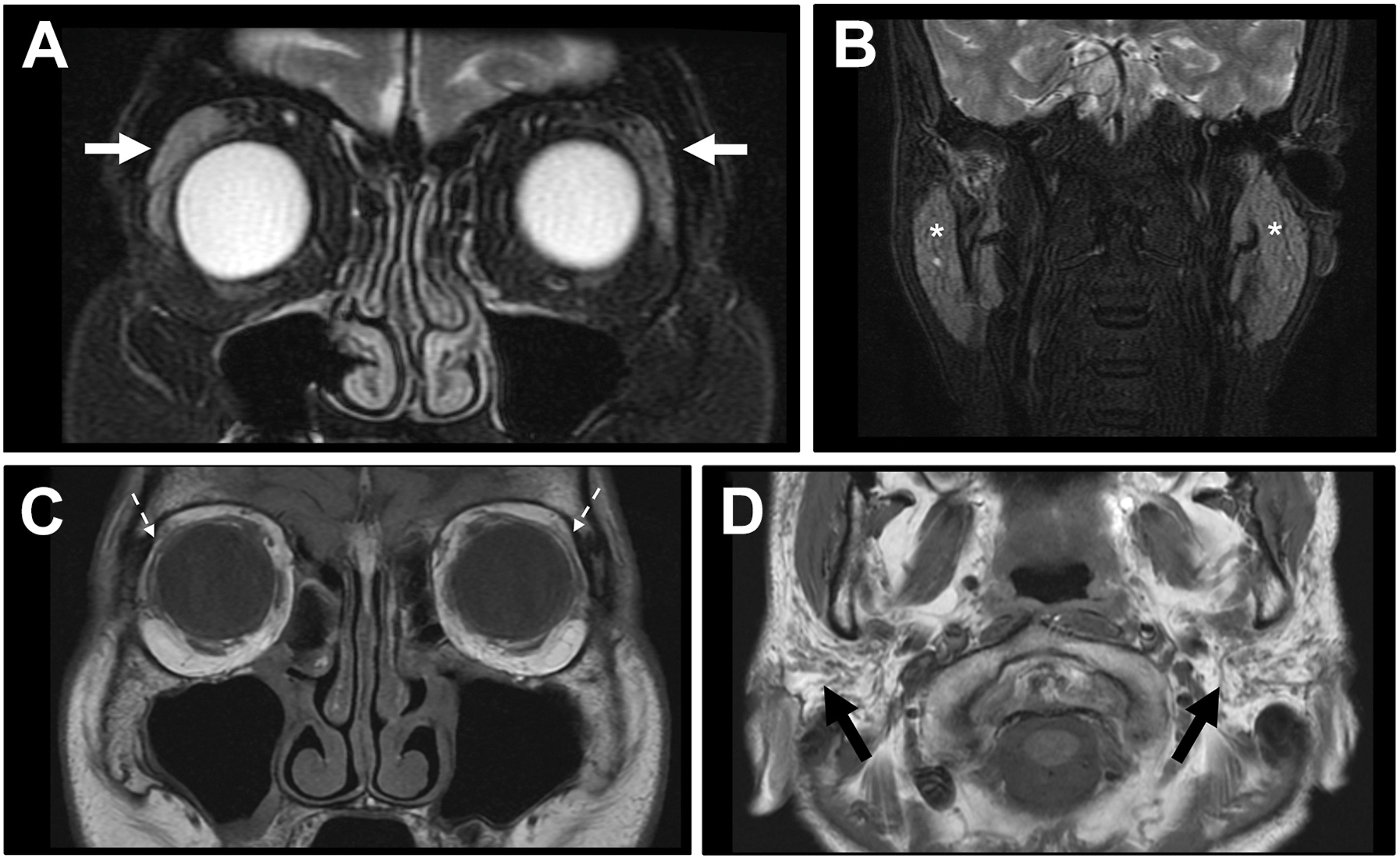 A four-panel magnetic resonance image shows Sjogren syndrome in two patients, illustrating enlarged lacrimal and parotid glands in acute disease, and fatty atrophy in chronic cases.