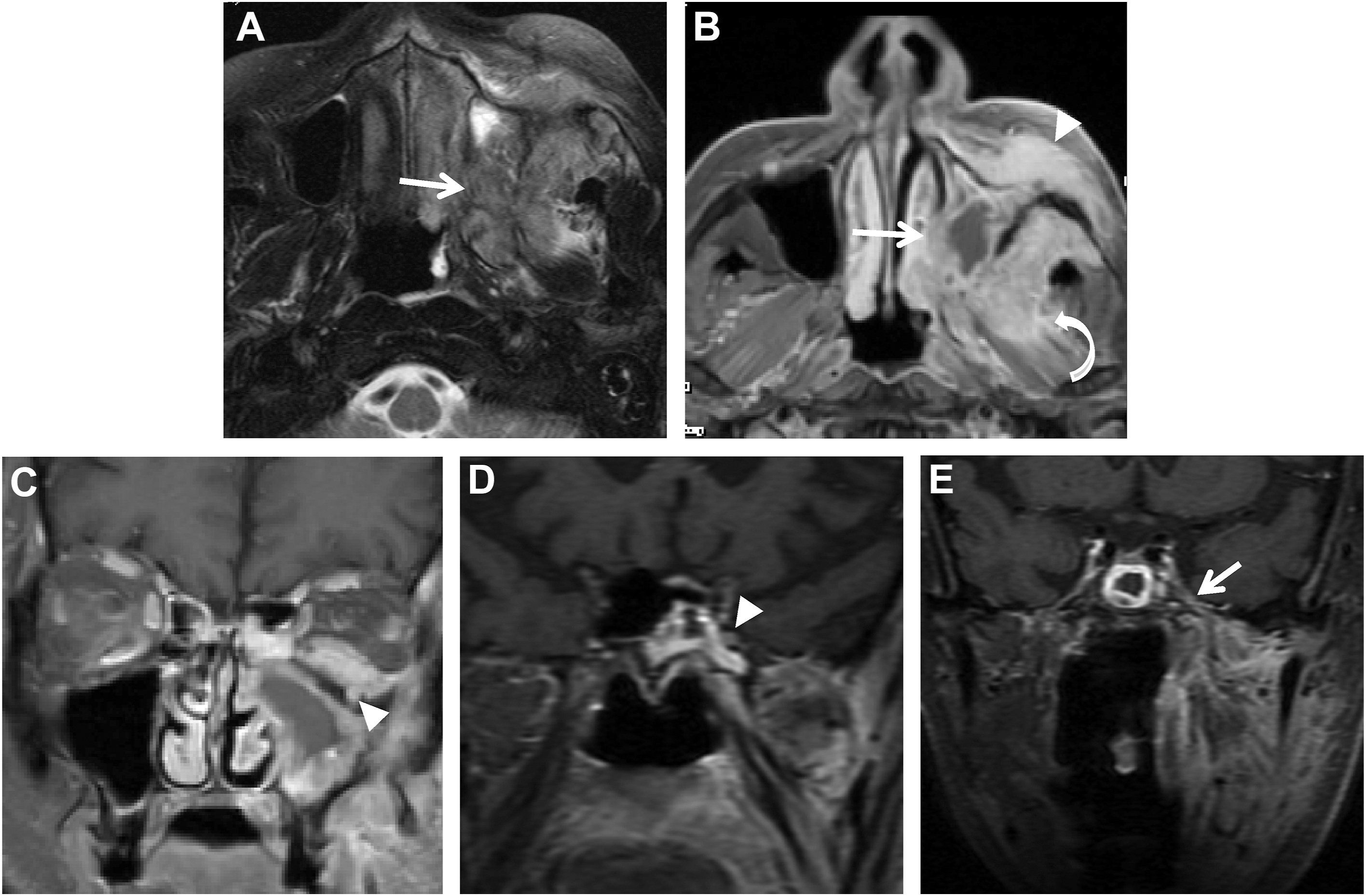 A five-panel magnetic resonance image series shows a left maxillary sinus tumor with perineural spread along trigeminal nerve branches.