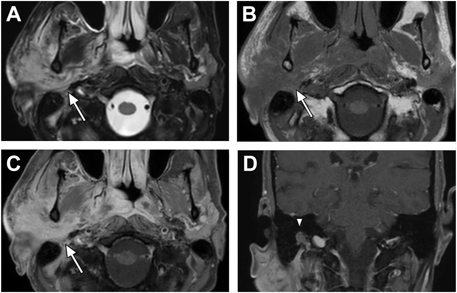 Four M R I scans show perineural spread along the mandibular nerve with arrows marking abnormal enhancement and thickening near the foramen ovale and pterygoid musculature.