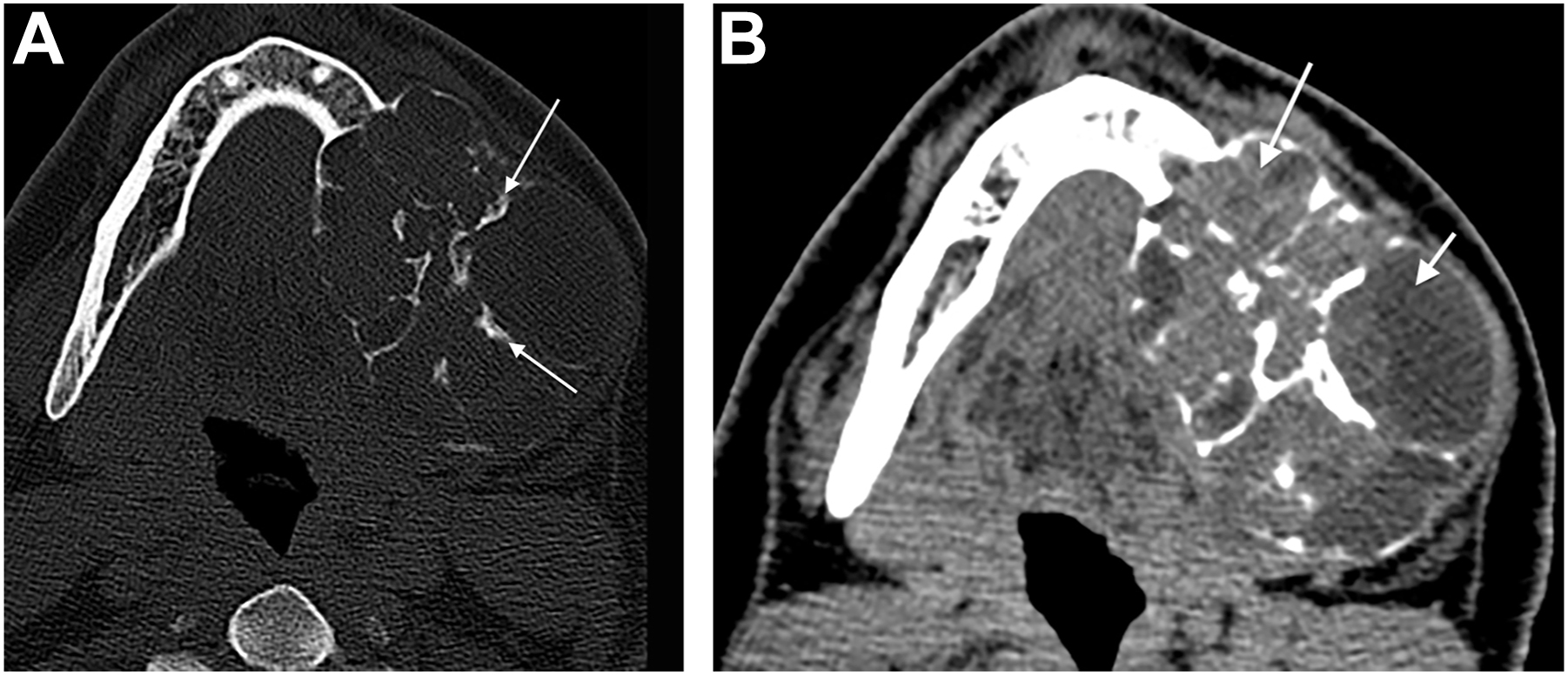 Two computed tomography scans show a mixed solid and cystic lesion in the mandible with heterogeneous internal content and lobulated margins.