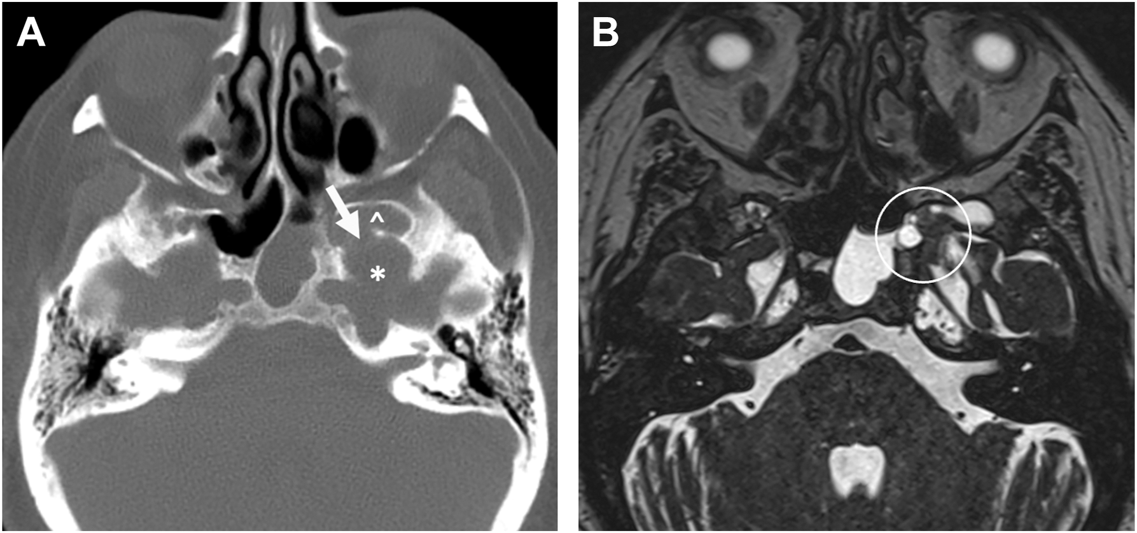 An axial C T and M R I scan pair displays a skull base mass marked by an arrow asterisk and arrowhead on the left and a circled lesion on the right affects adjacent structures.