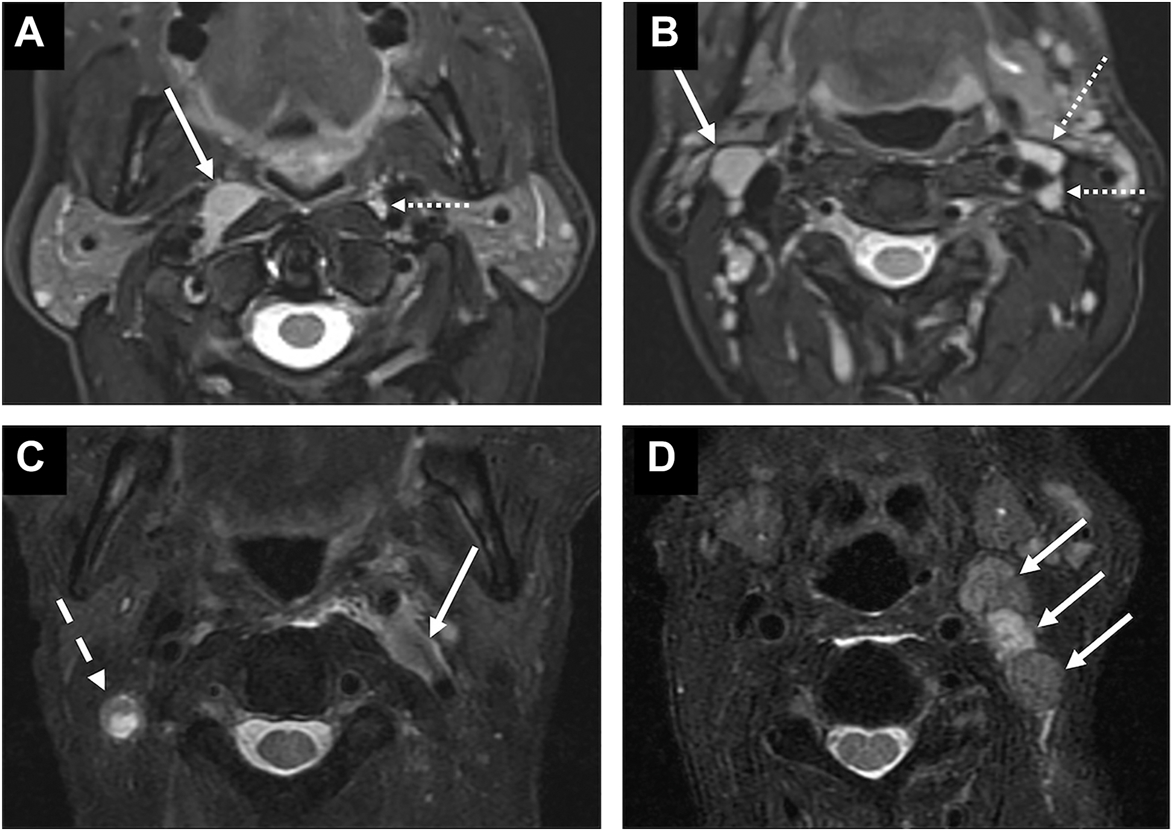 An M R I panel labeled A to D shows axial views of the neck with arrows pointing to enlarged lymph nodes and soft tissue masses in various cervical regions.