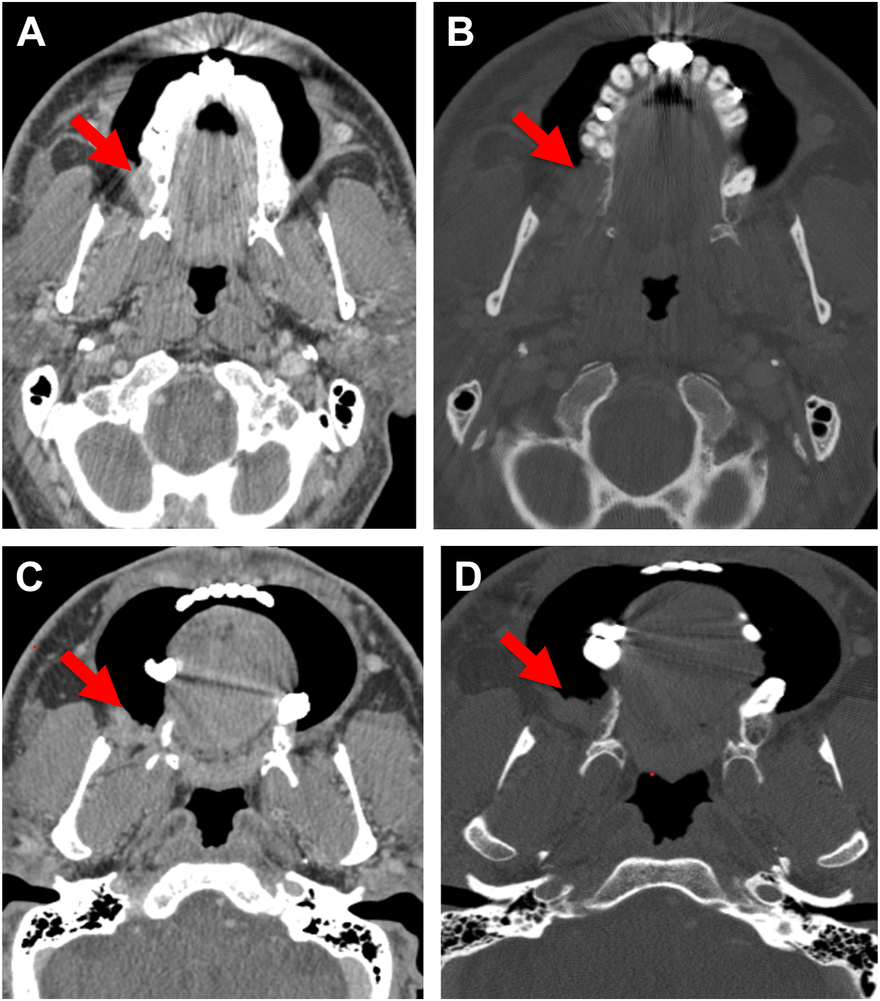 Four post contrast C T scans depict right buccal S C C initially read as T 4 a due to suspected bone erosion, follow up with puffed cheek scanning improves visualization of tumor and bone.