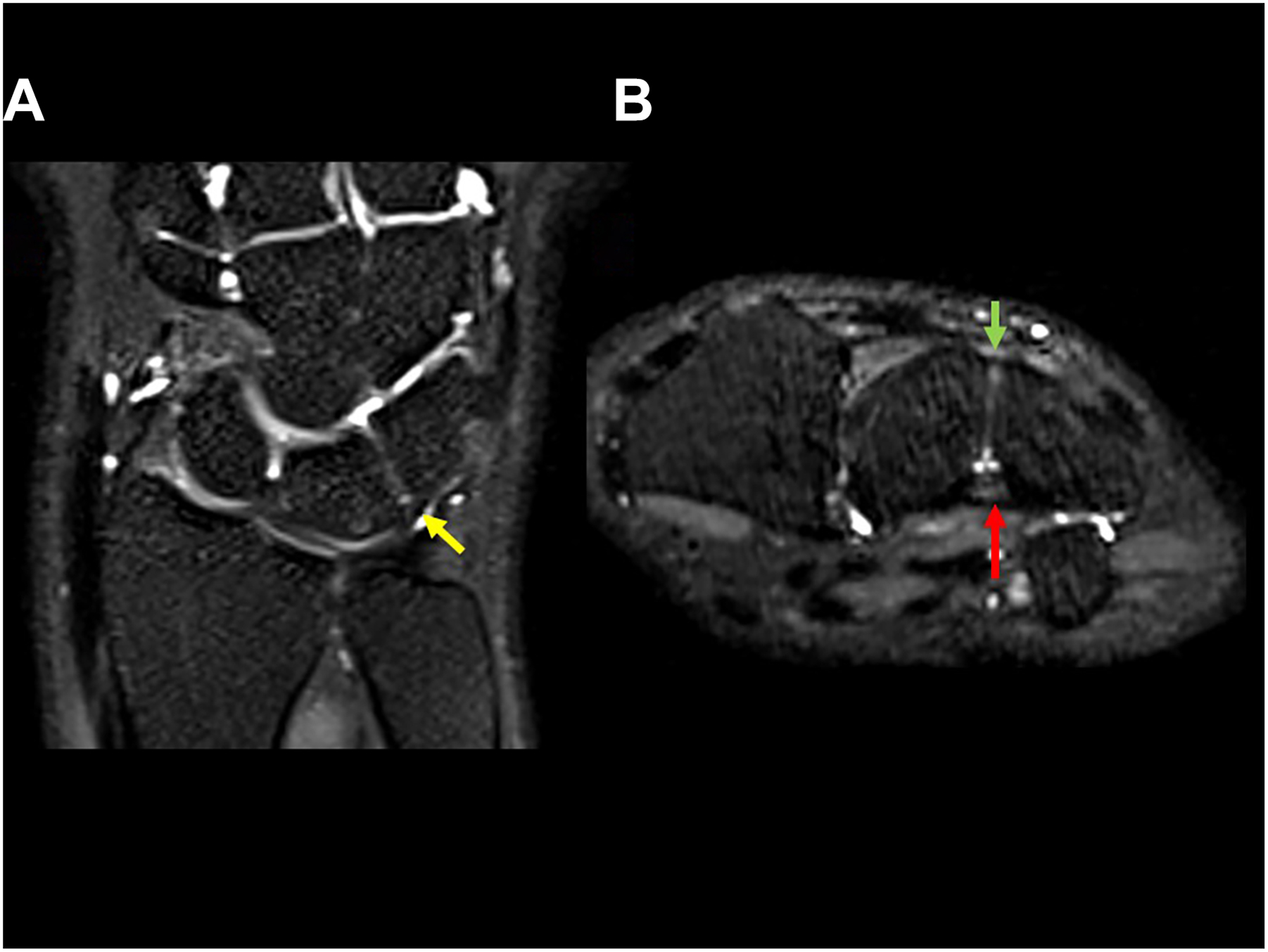 Two M R I scans of a wrist show a proximal component of the lunotriquetral ligament, dorsal, and volar components.